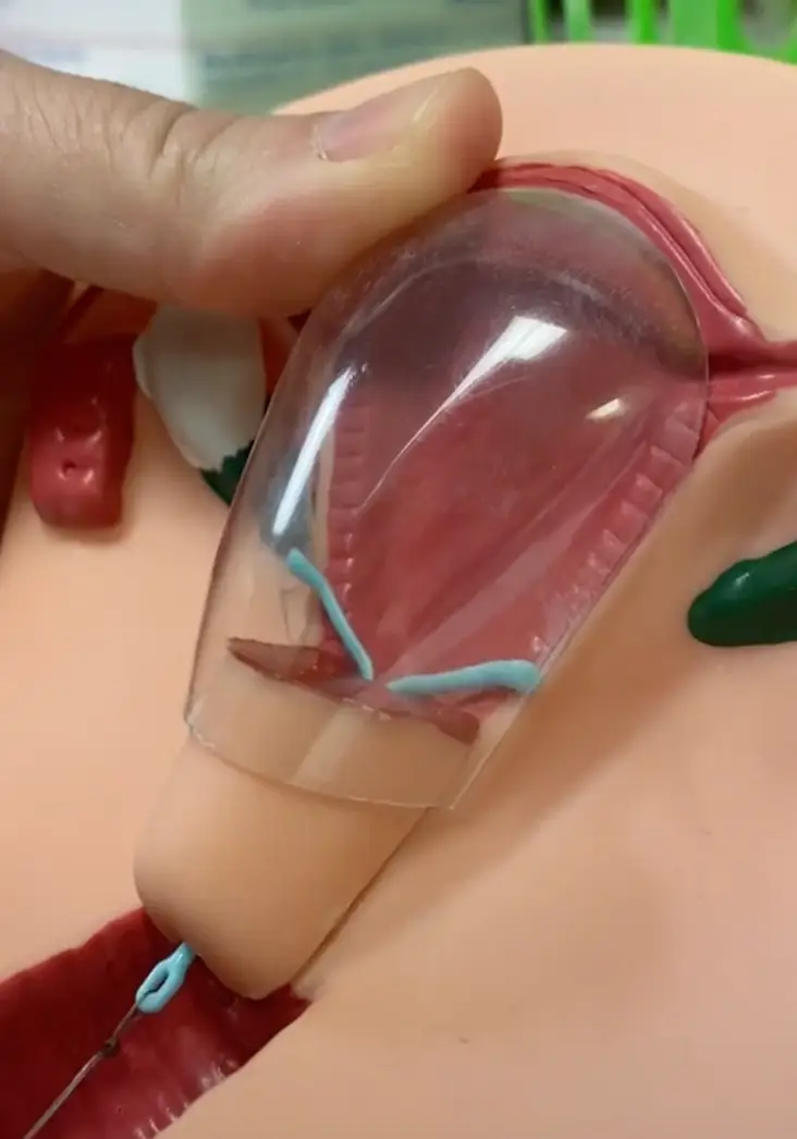 The video showed how an IUD is removed (