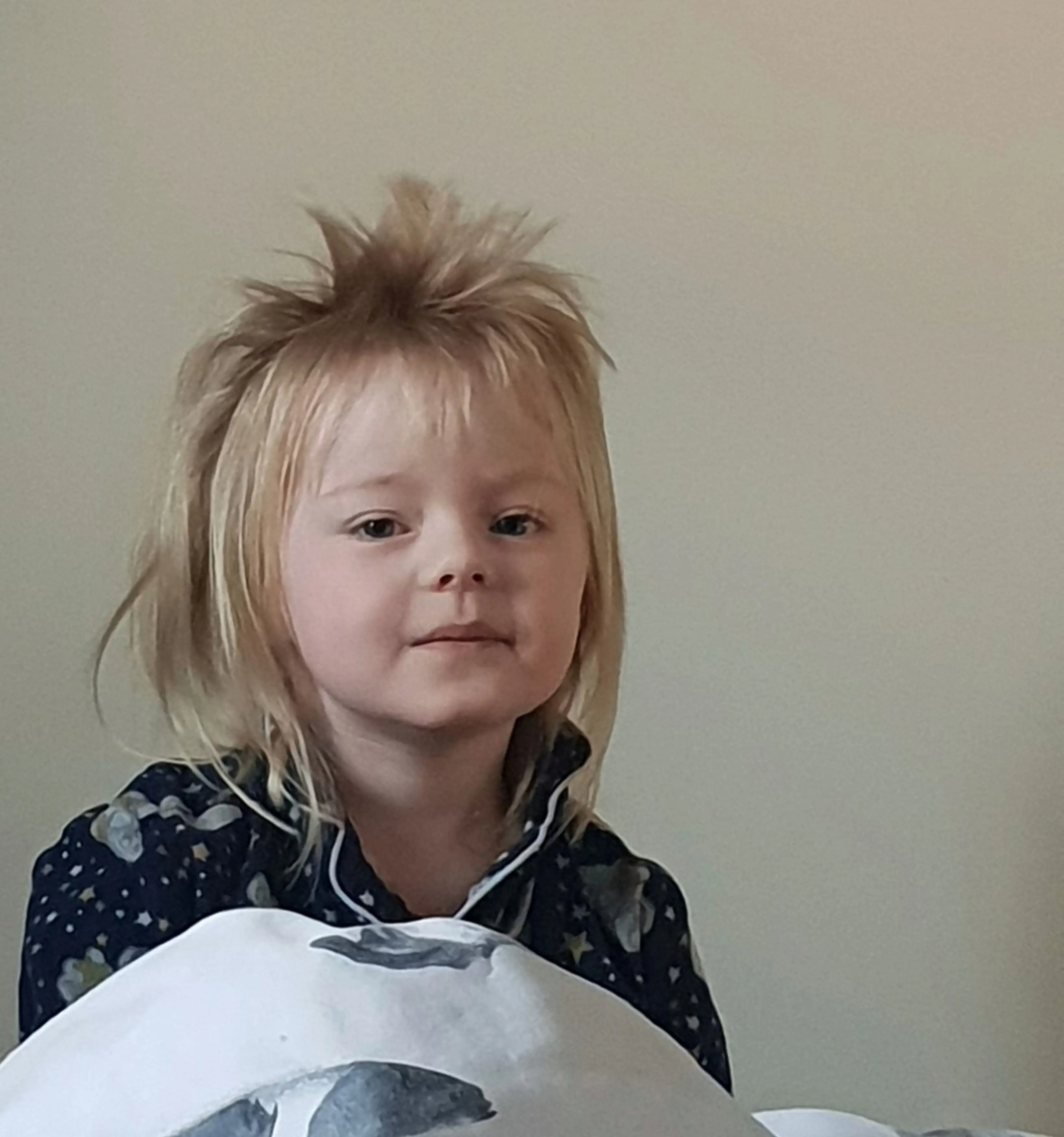 The toddler was left looking like David Bowie as her hair began to grow back (