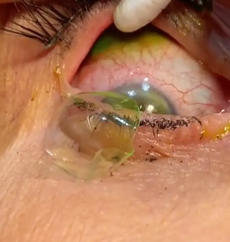 It's stomach-turning to look at (california_eye_associates/Instagram)