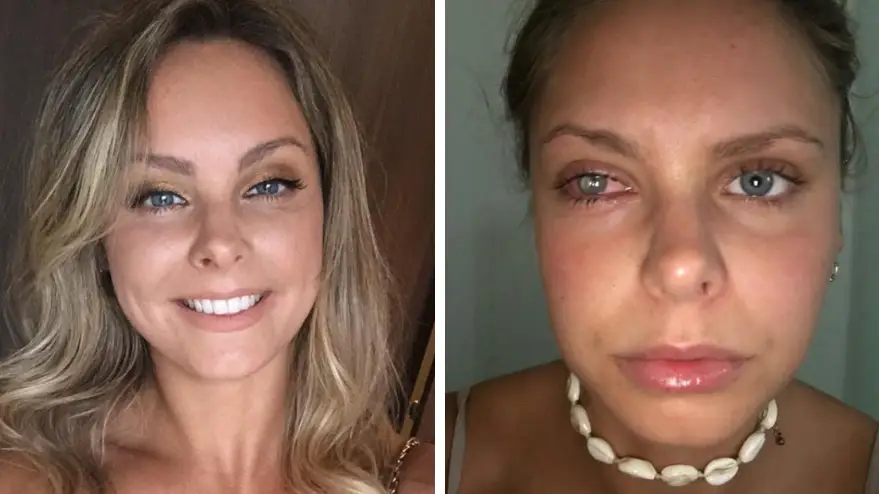 Woman left half blinded after getting infection in her eye 'from dirty make up bag'