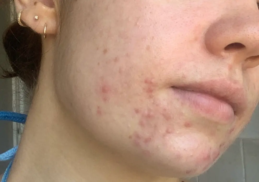 I used La Roche Posay products to keep my acne at bay following treatment 