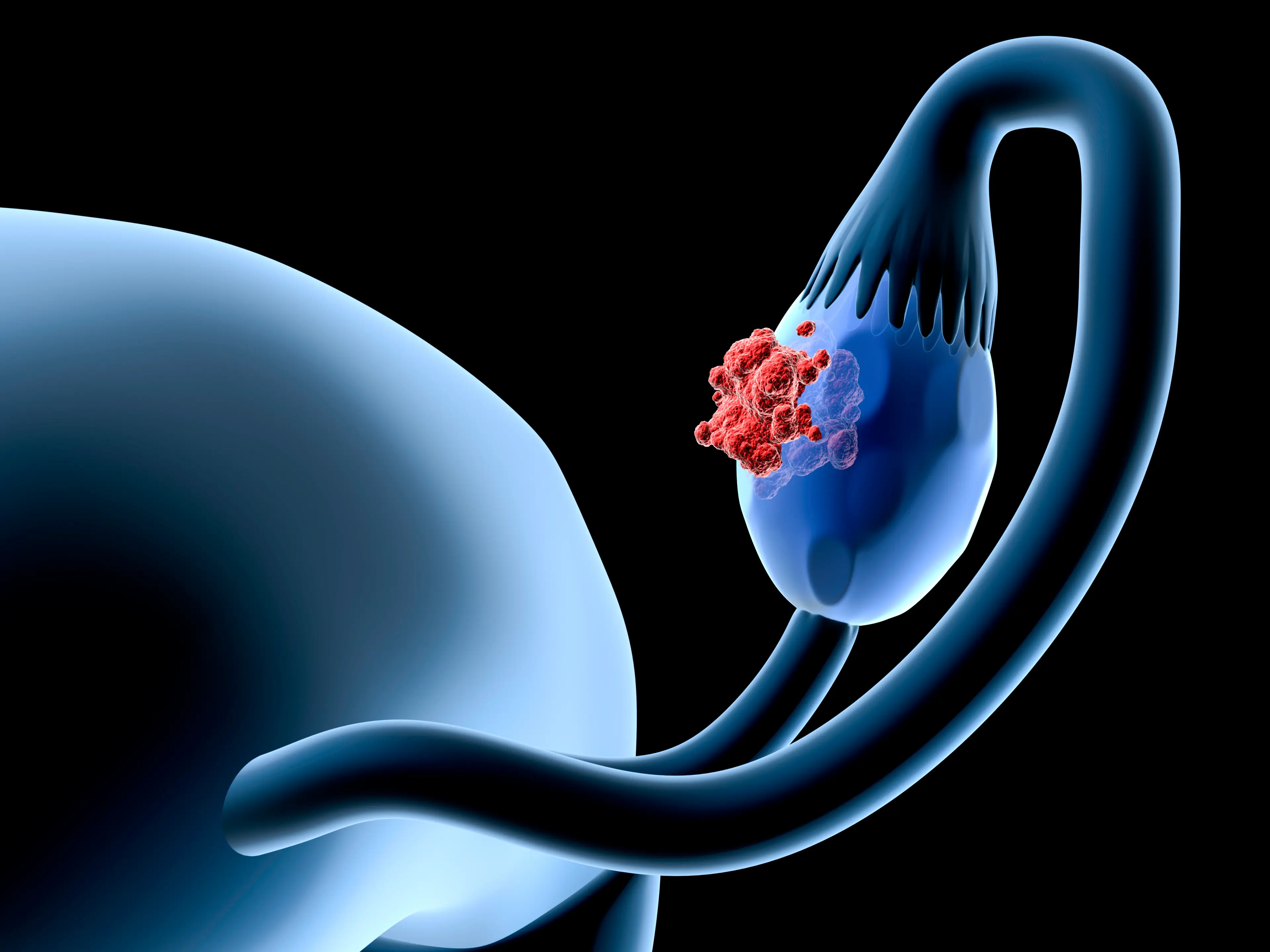 Ovarian cancer is the 16th most common cancer in the UK (Getty Stock Images)