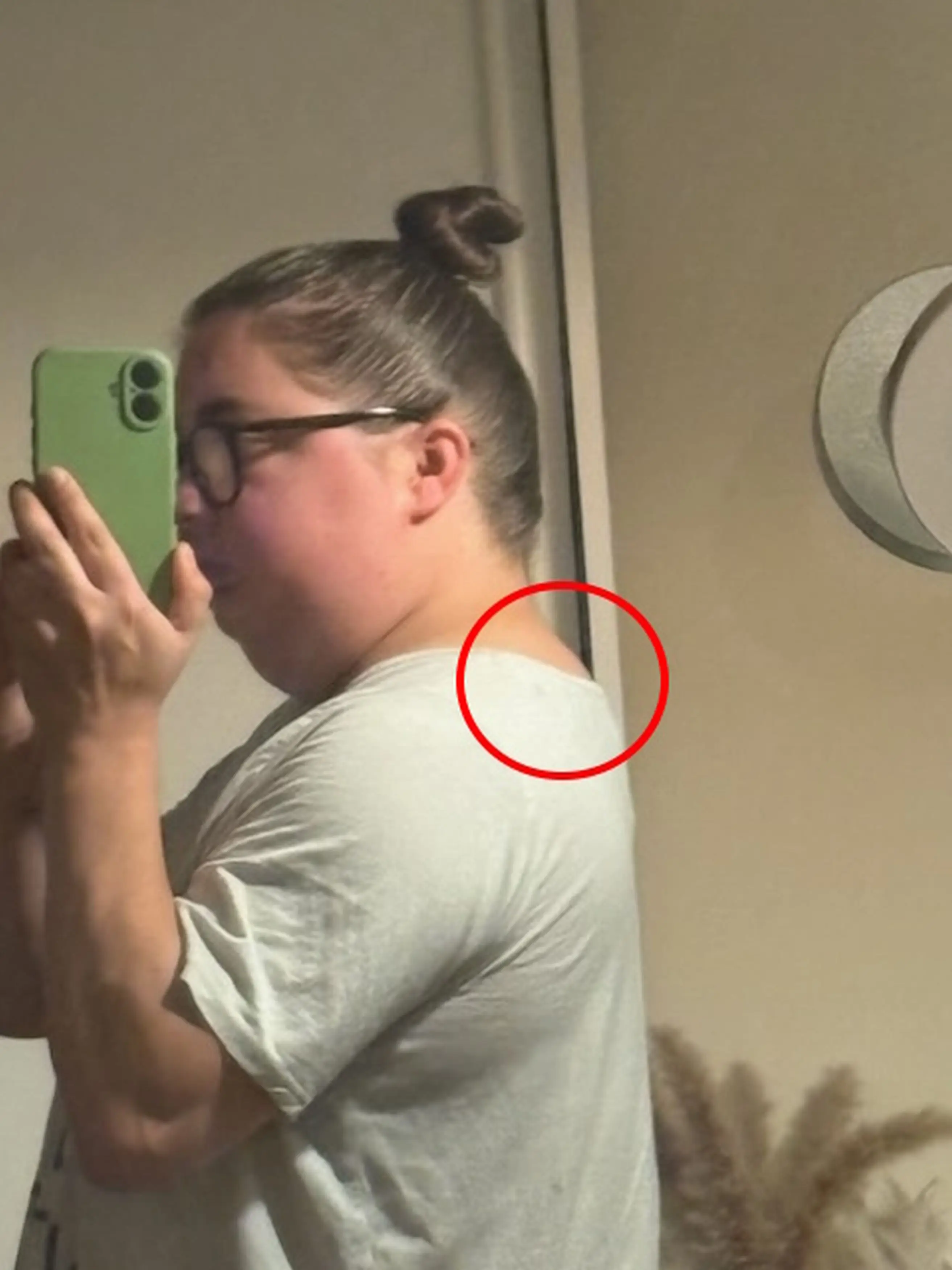 A round face and 'Buffalo bump' are common symptoms of Cushing's disease (Kennedy News and Media)