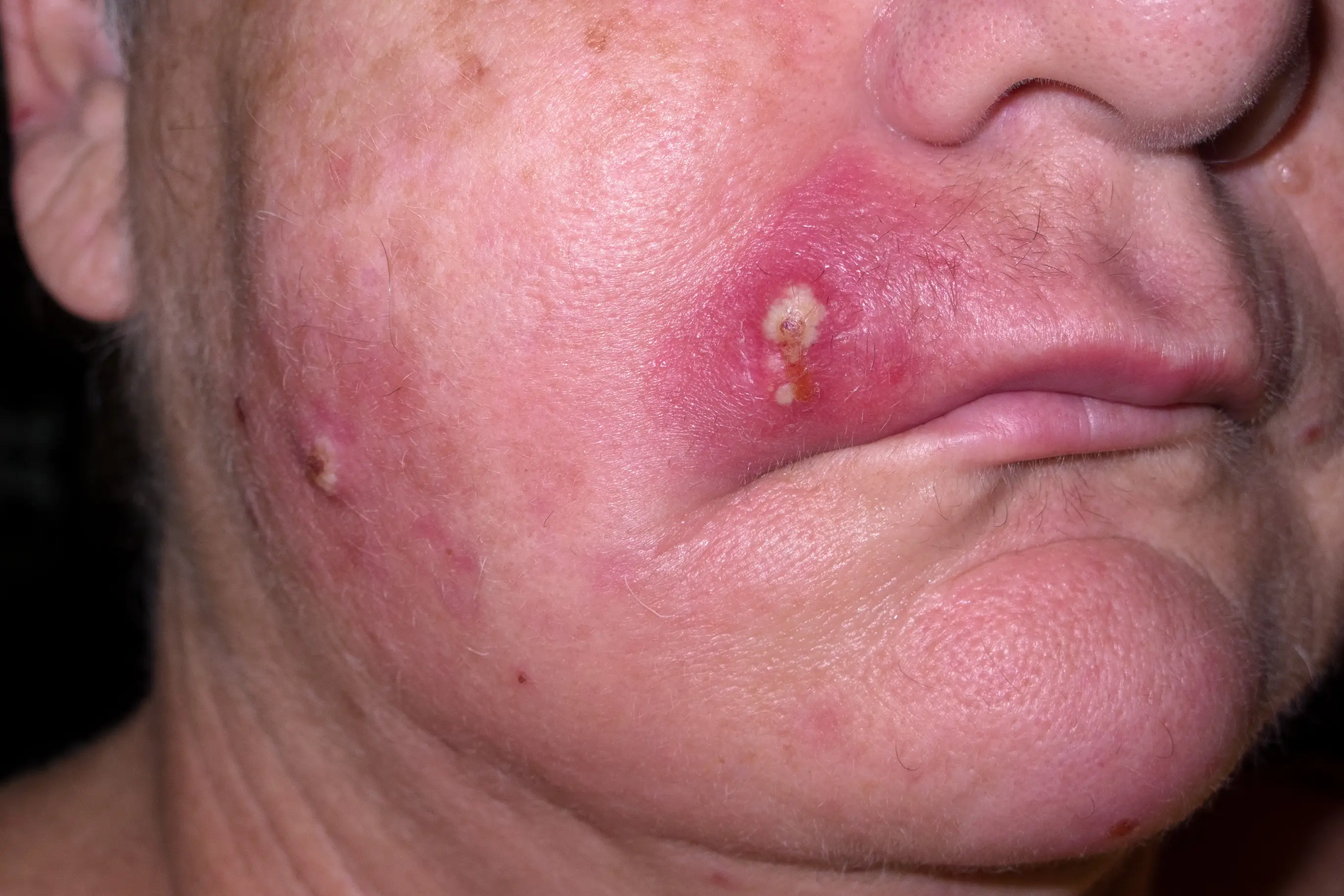 A staph infection on the face (Getty Stock Images)