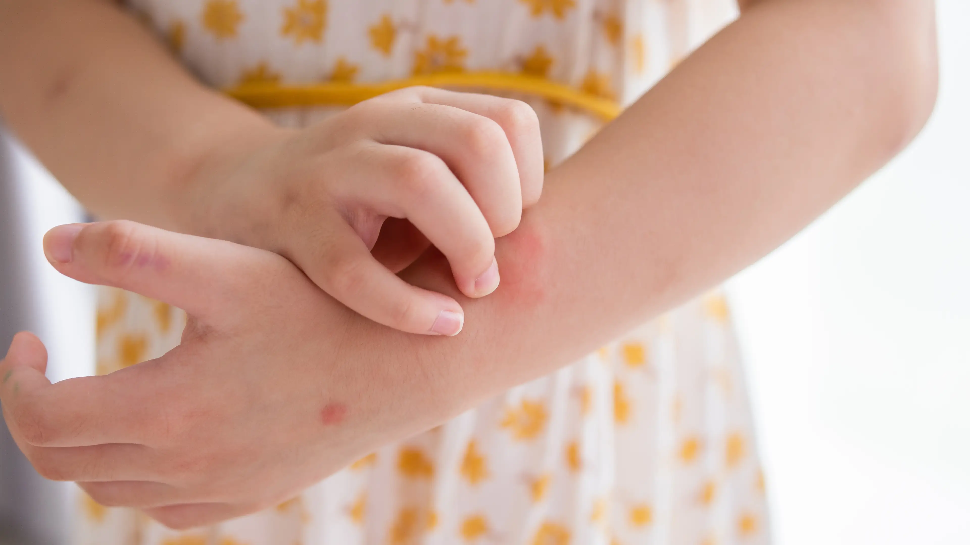 6 red flags that could mean you have histamine intolerance without realising