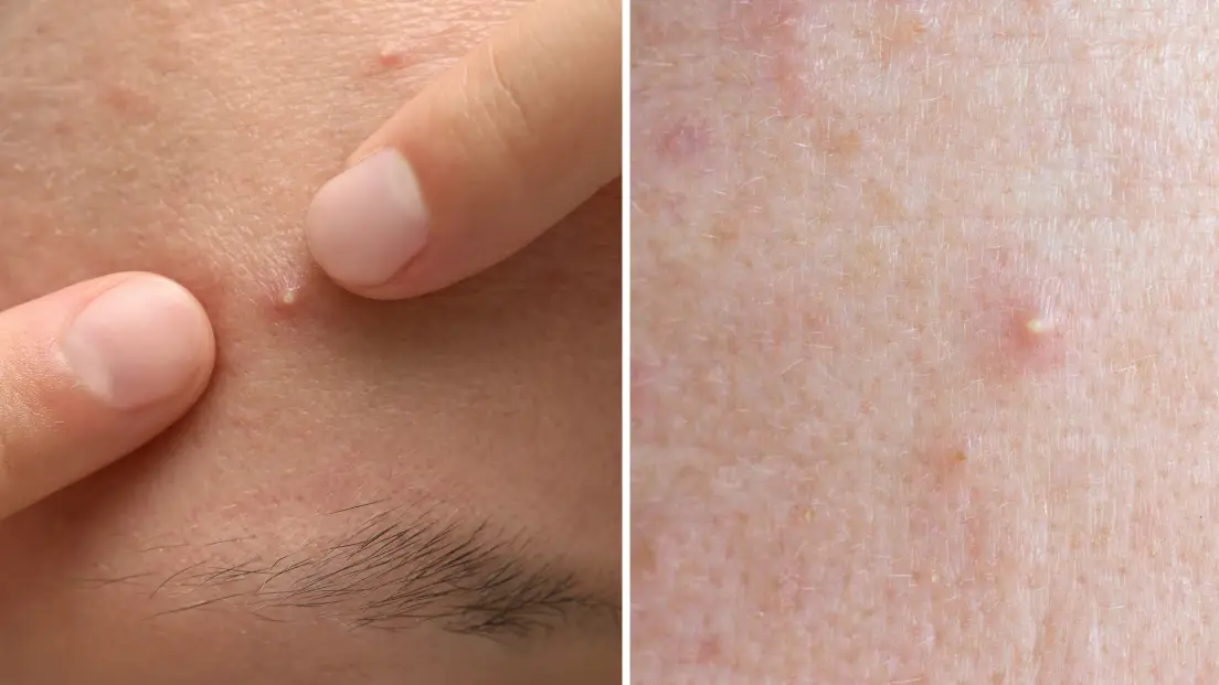 Dermatologist reveals disturbing reason you should never pop your own spots