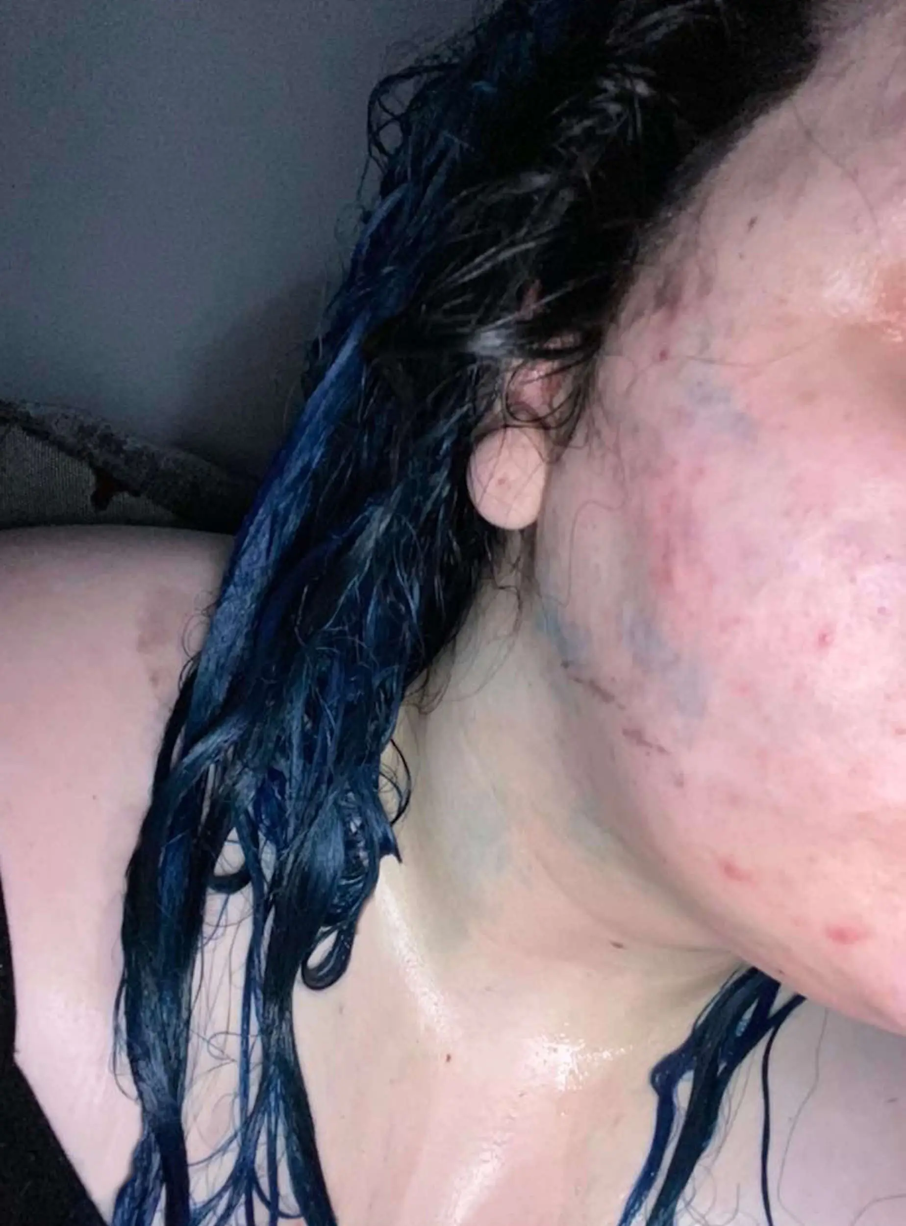 Whole sections of Shannon's hair had to be cut off (