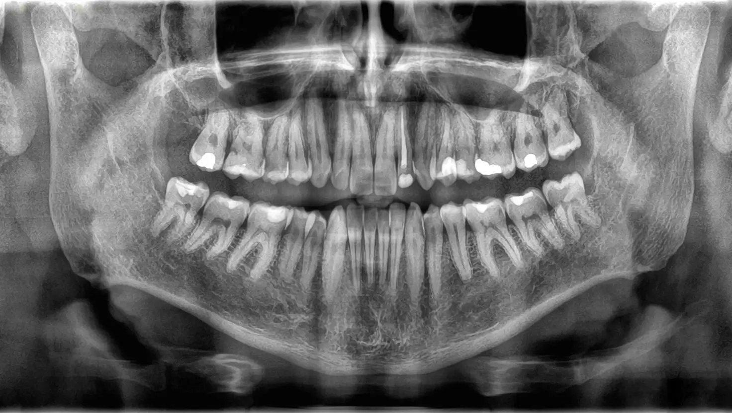 The so-called 'skinny jabs' could cause you to drink less, thus promoting gum disease, according to experts (Getty Stock Image)