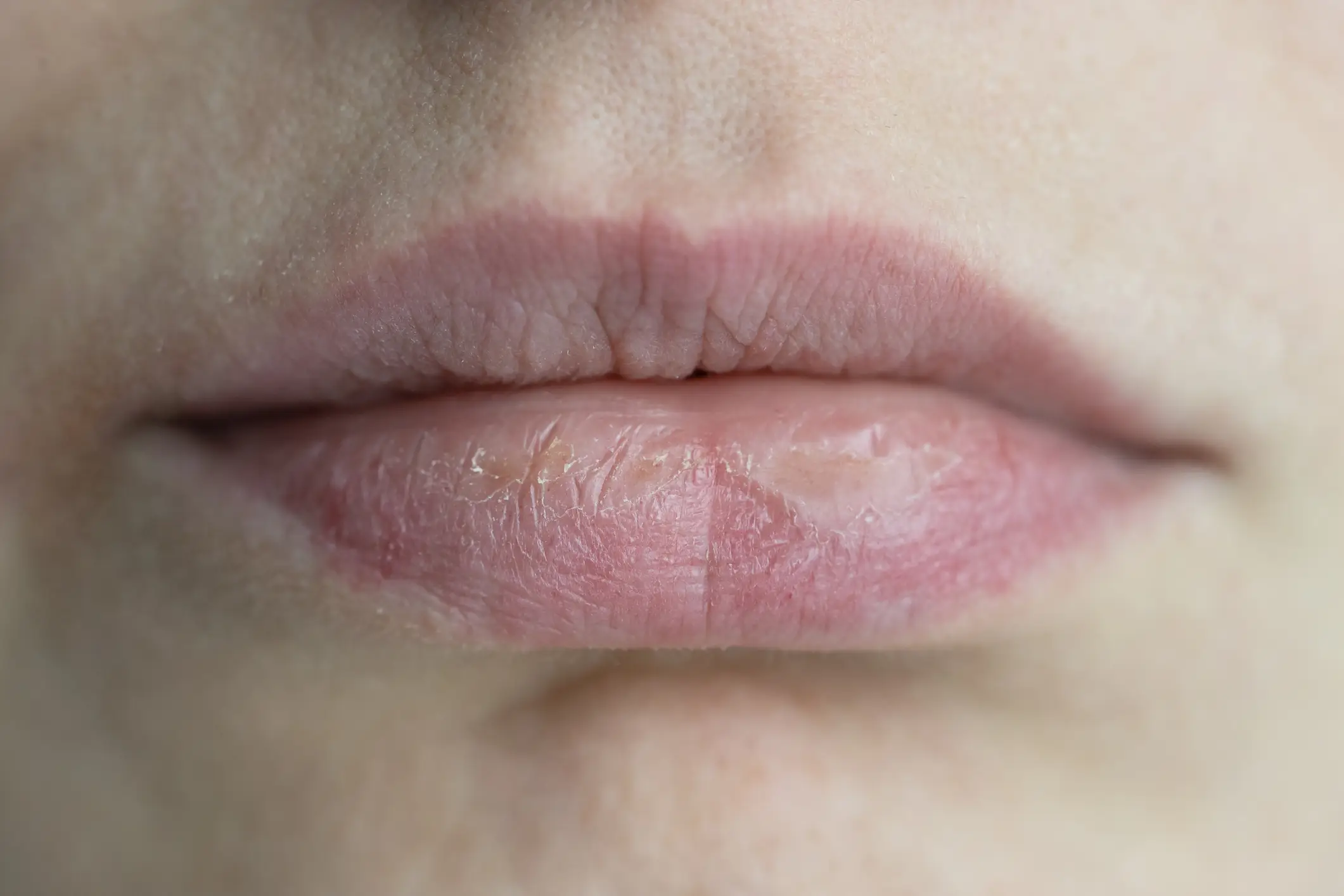Anyone with constantly cracked or dry lips - listen up! (Getty Stock Images)