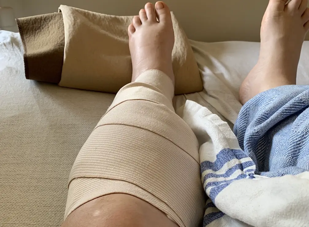 Julia's legs swelled dramatically overnight.