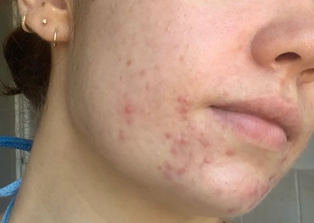 I struggled with hormonal acne well into my early twenties and acne medication compromised my skin barrier