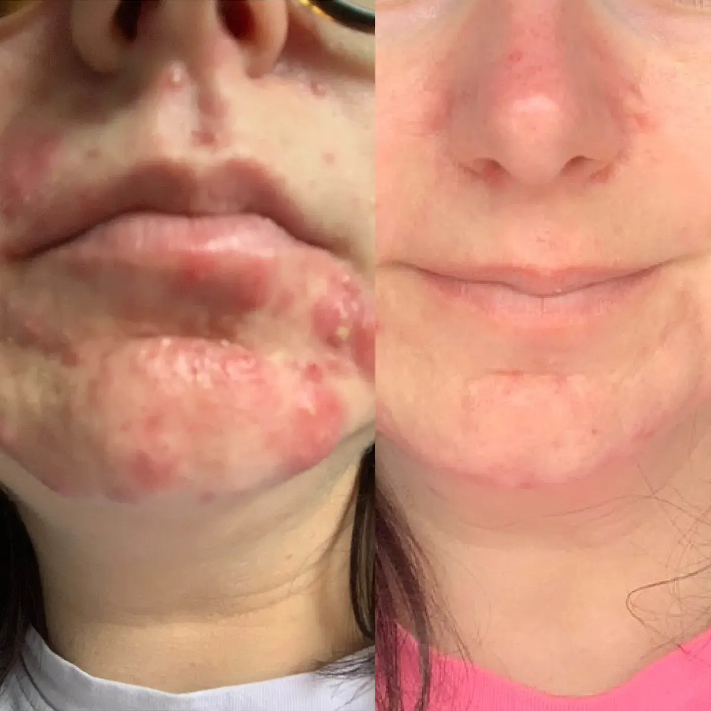 Women have said the treatment bundle can 'reduce acne in weeks' (47 Skin)