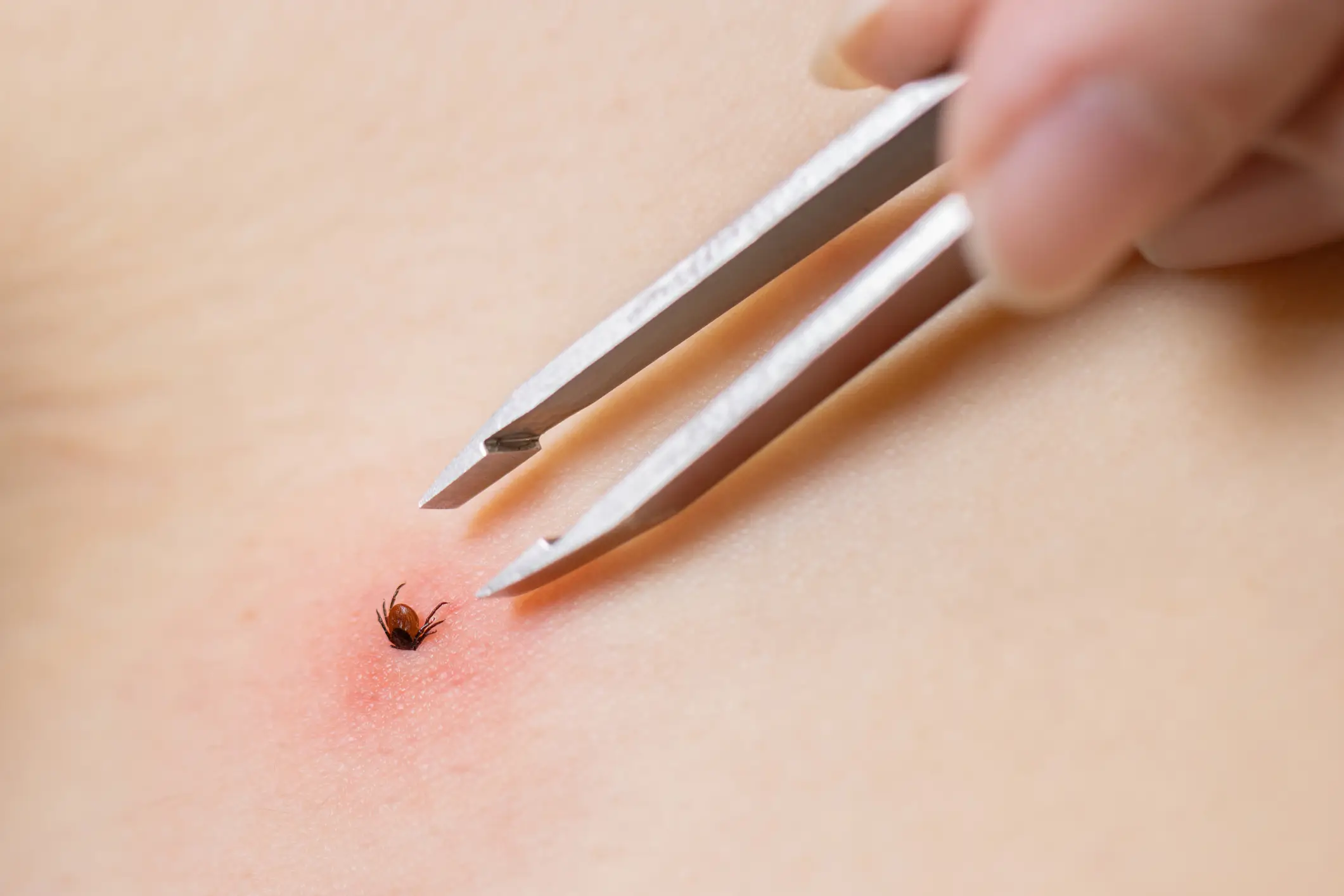 Lyme disease is a bacterial infection that's spread by tick bites (Getty Stock Image)
