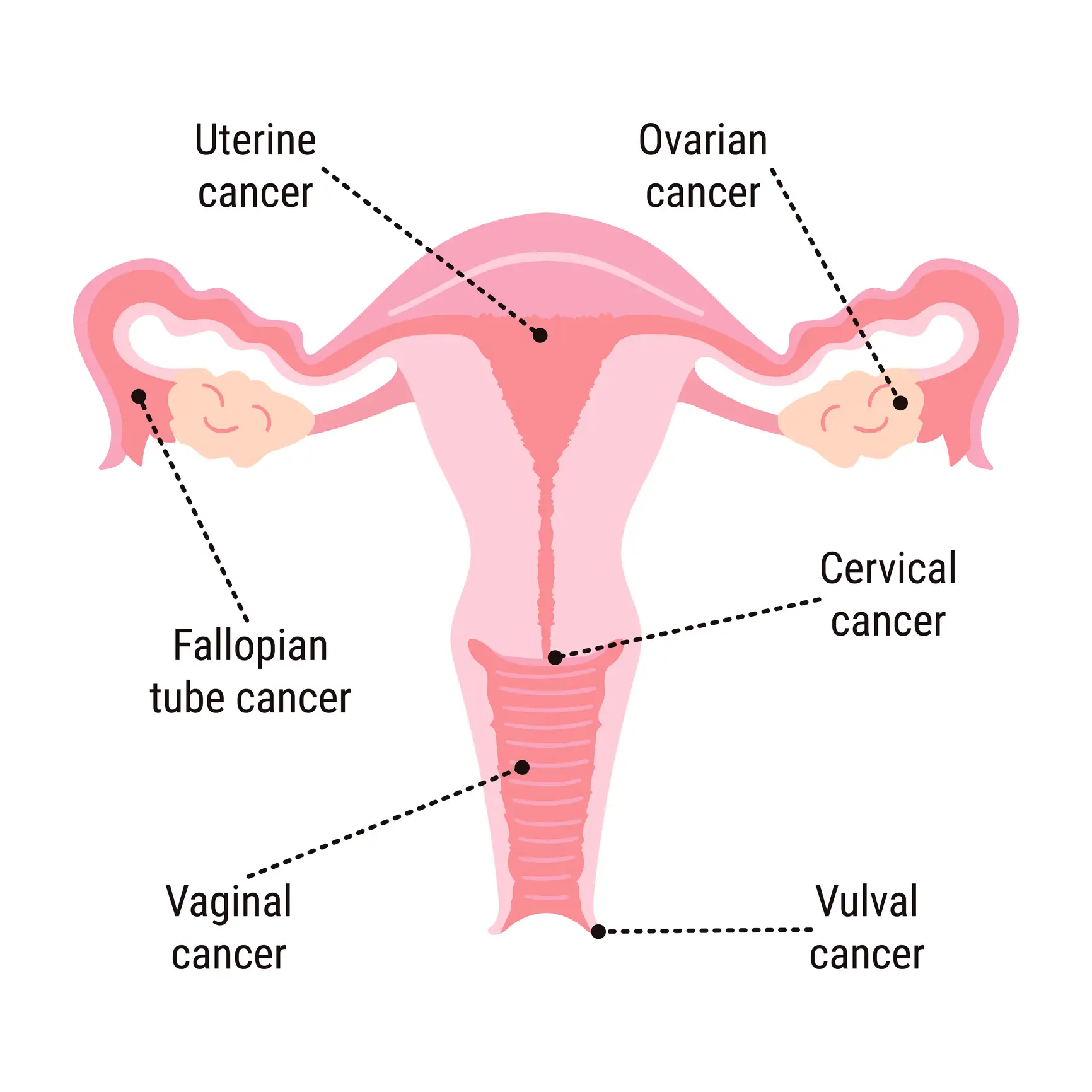 Vaginal cancer occurs when cancer grows in the lining of the vagina and largely affects women over the age of 75 (m.malinika/Getty Images)