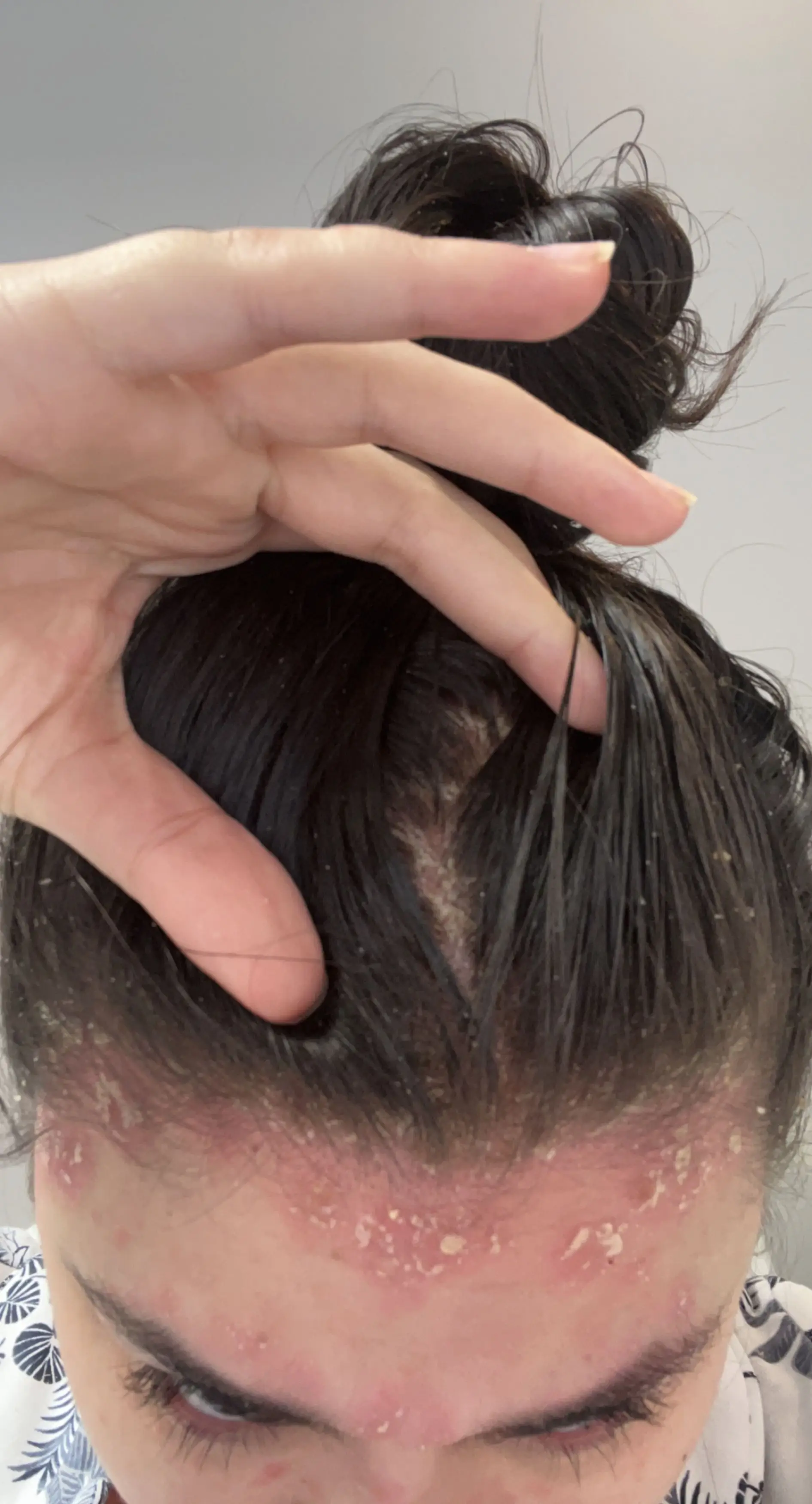 The condition even affects her hair.