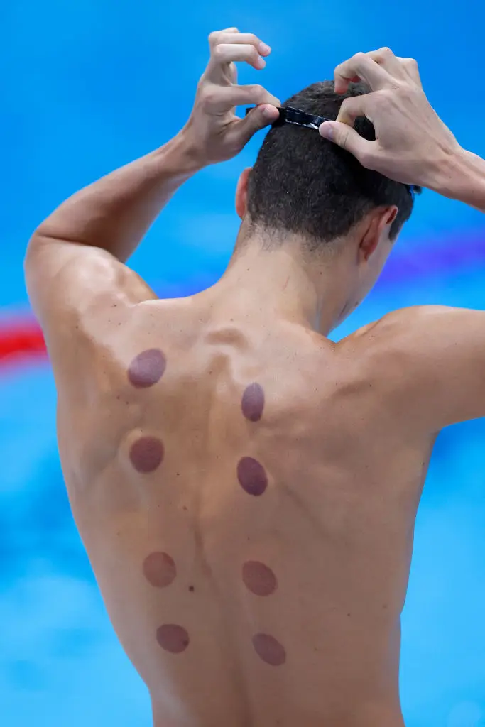 The ancient massage therapy is used as pain relief. (Al Bello / Staff / Getty Images)