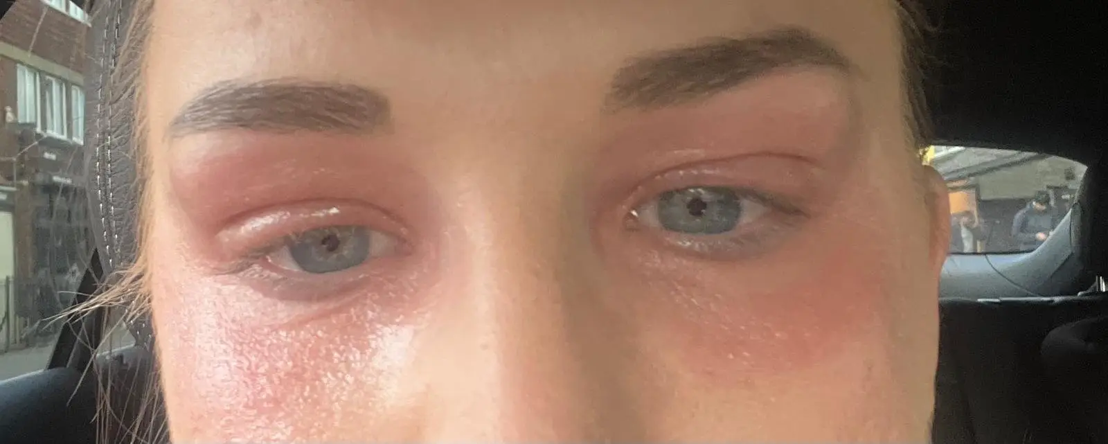 Georgina's eyes were severely affected. (SWNS)