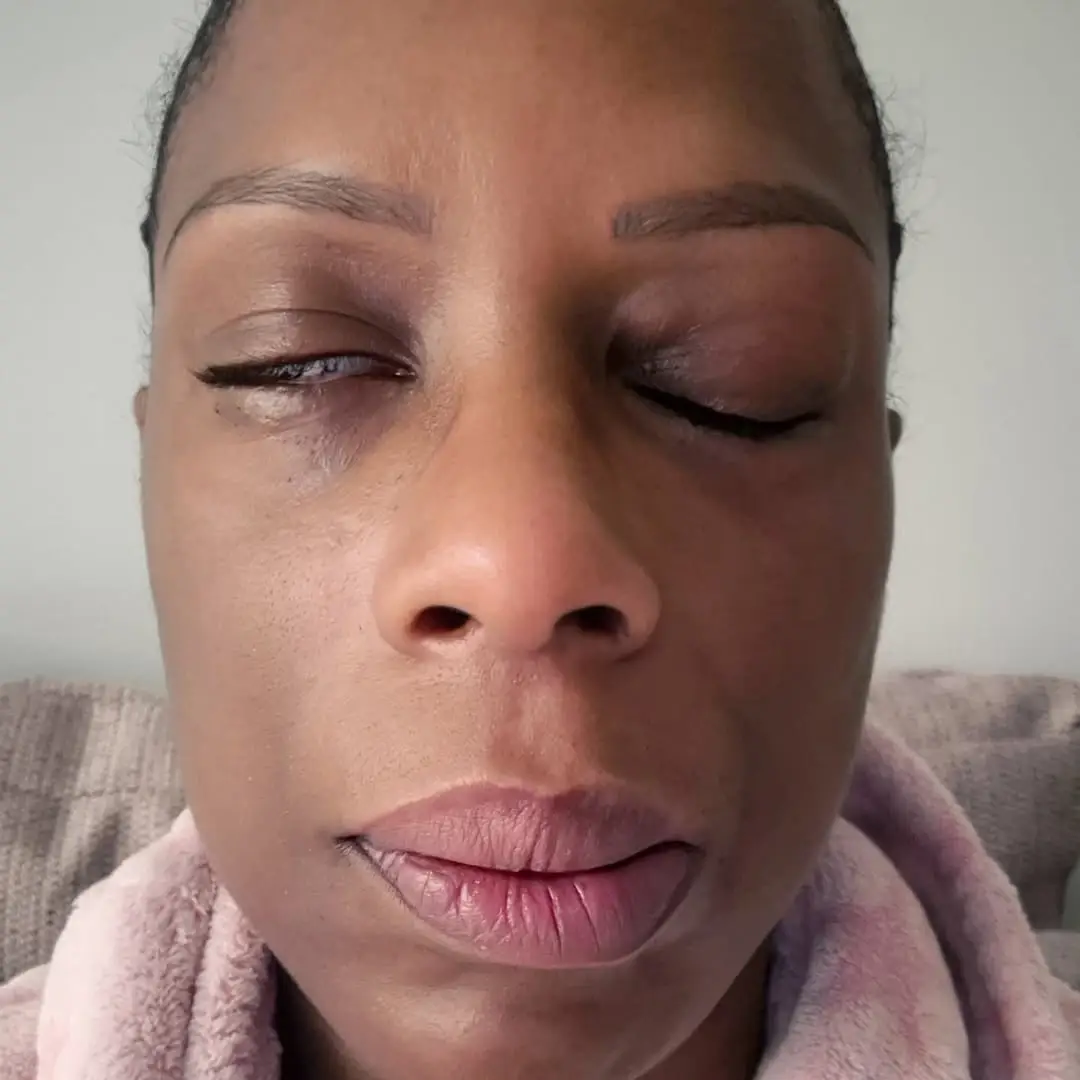 Fruitcake shared images of her experience with Bell's Palsy (Instagram/@fruitcake_fundamentals)