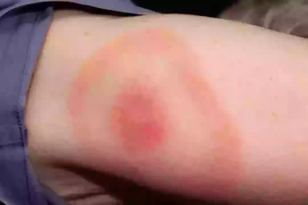 This is the rash you should be looking out for (NHS)