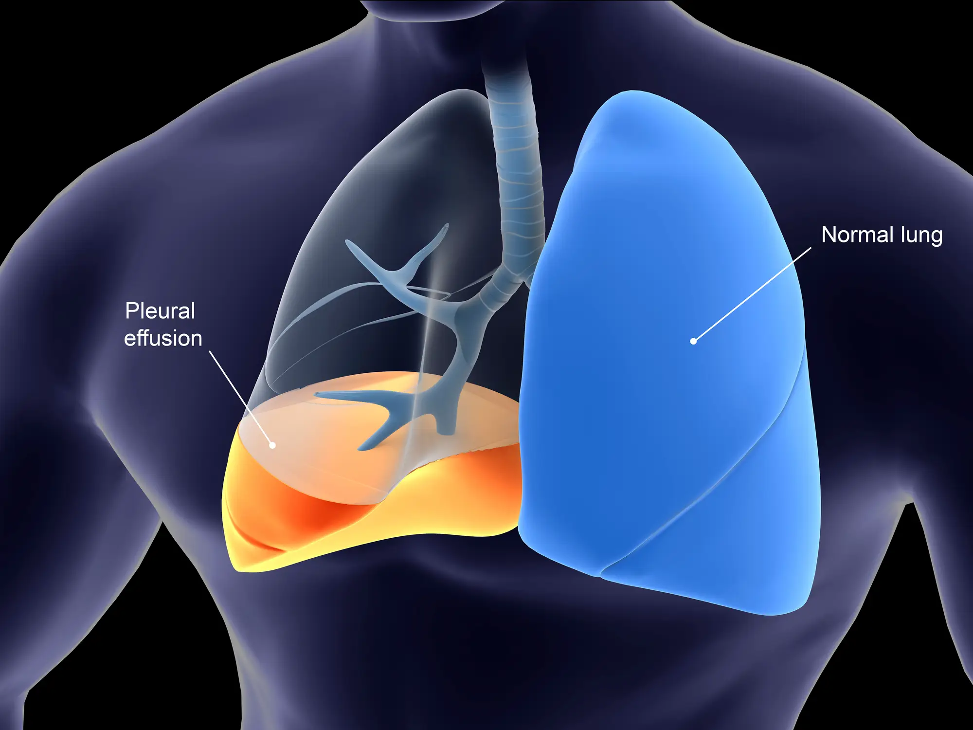 She had a pleural effusion (Getty Stock Images)