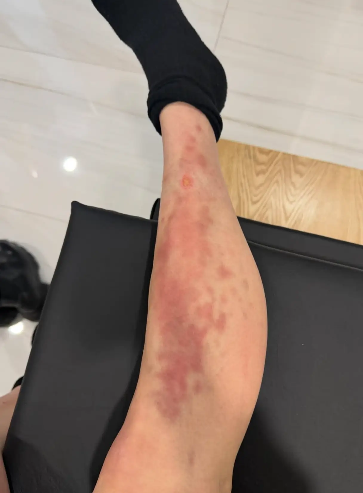 The singer shared a picture of the nasty bite on Instagram (Instagram/taylormomsen)