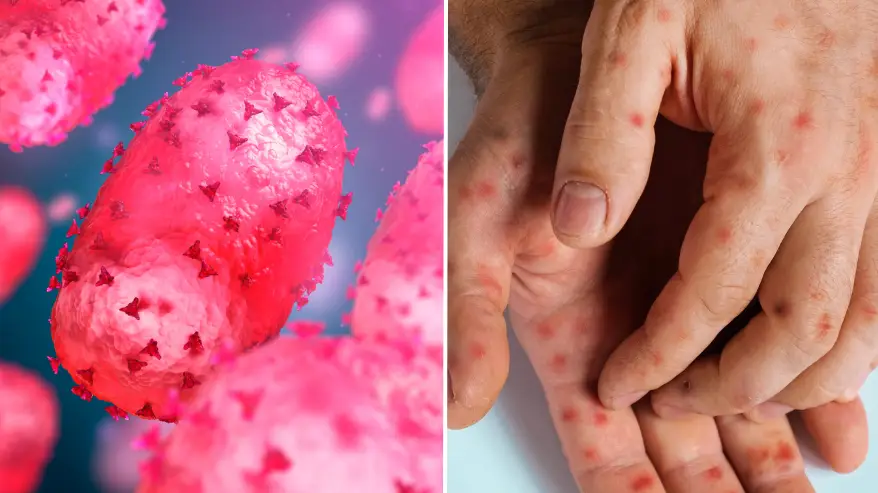 Reason why mpox isn’t called monkeypox anymore as UK prepares for outbreak