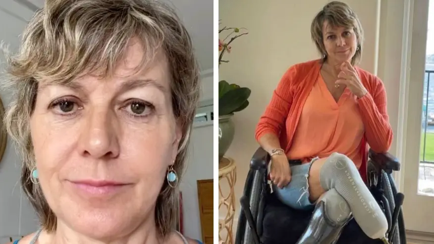 Woman urges people to recognise sepsis symptoms after losing her fingertips and legs