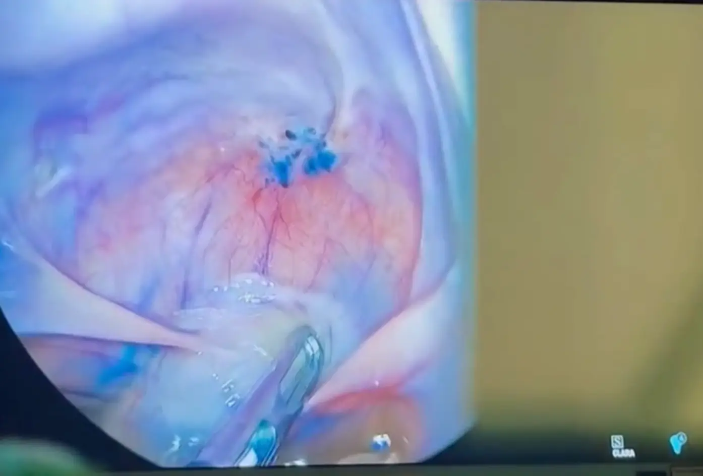 A new BBC documentary about endometriosis has been praised for shining a light on the realities of the 'excrutiating' health condition (BBC)