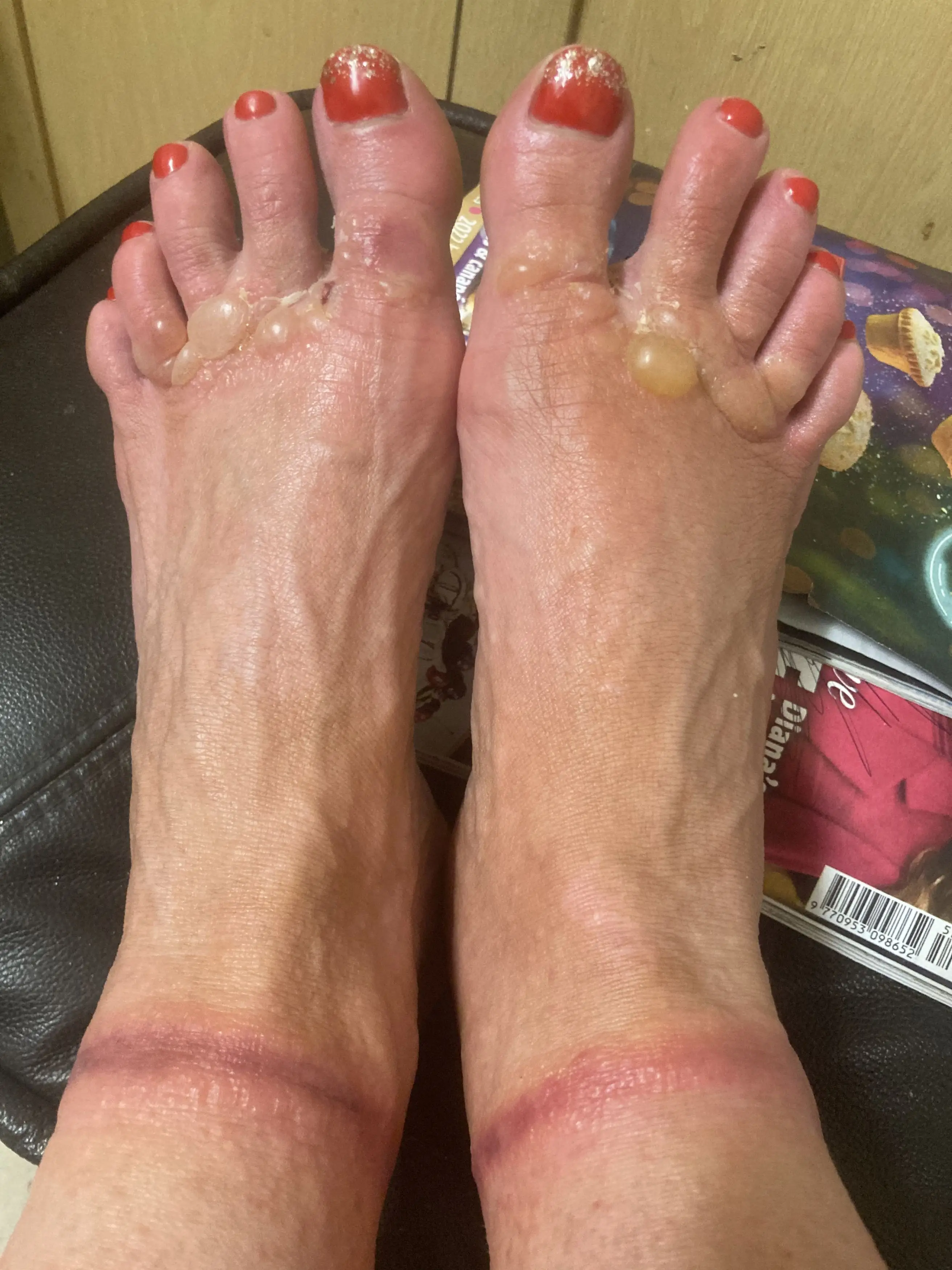 A number of painful blisters and welts erupted on her skin (