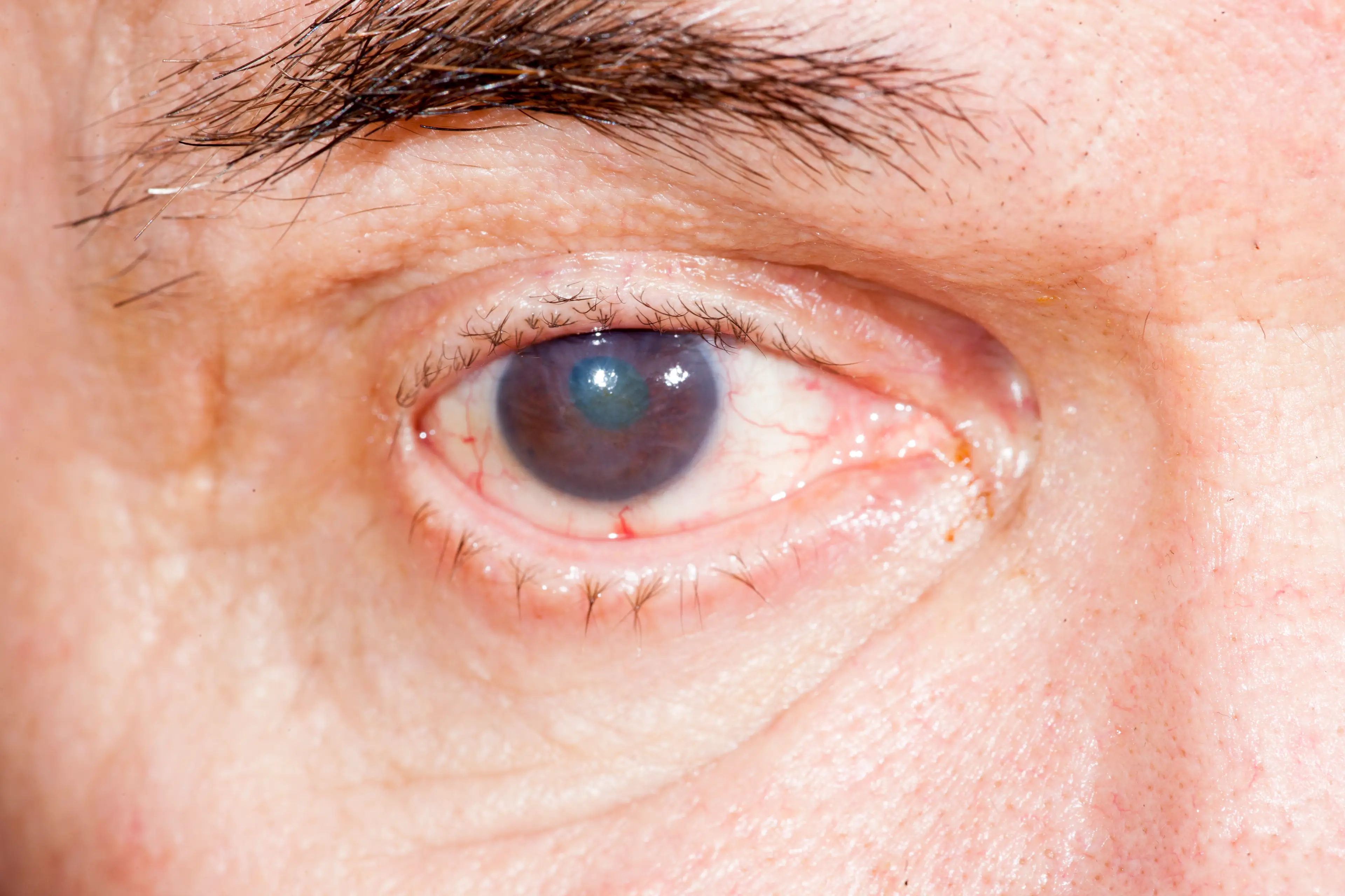 Surgery is the only treatment that's proven to be effective for cataracts (Getty Stock Images)