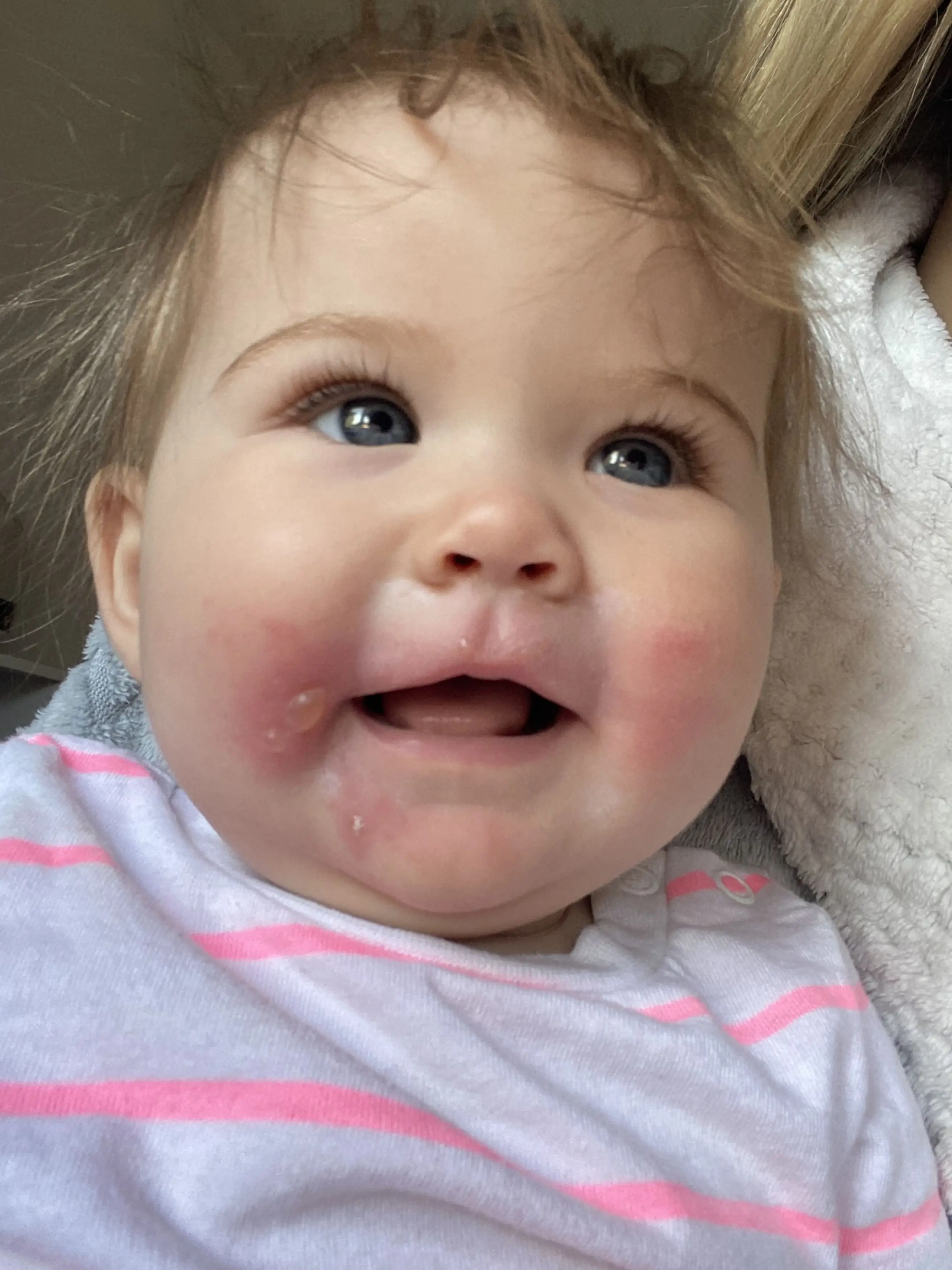 The infant's face was covered with fluid-filled blisters. (Kennedy News and Media)