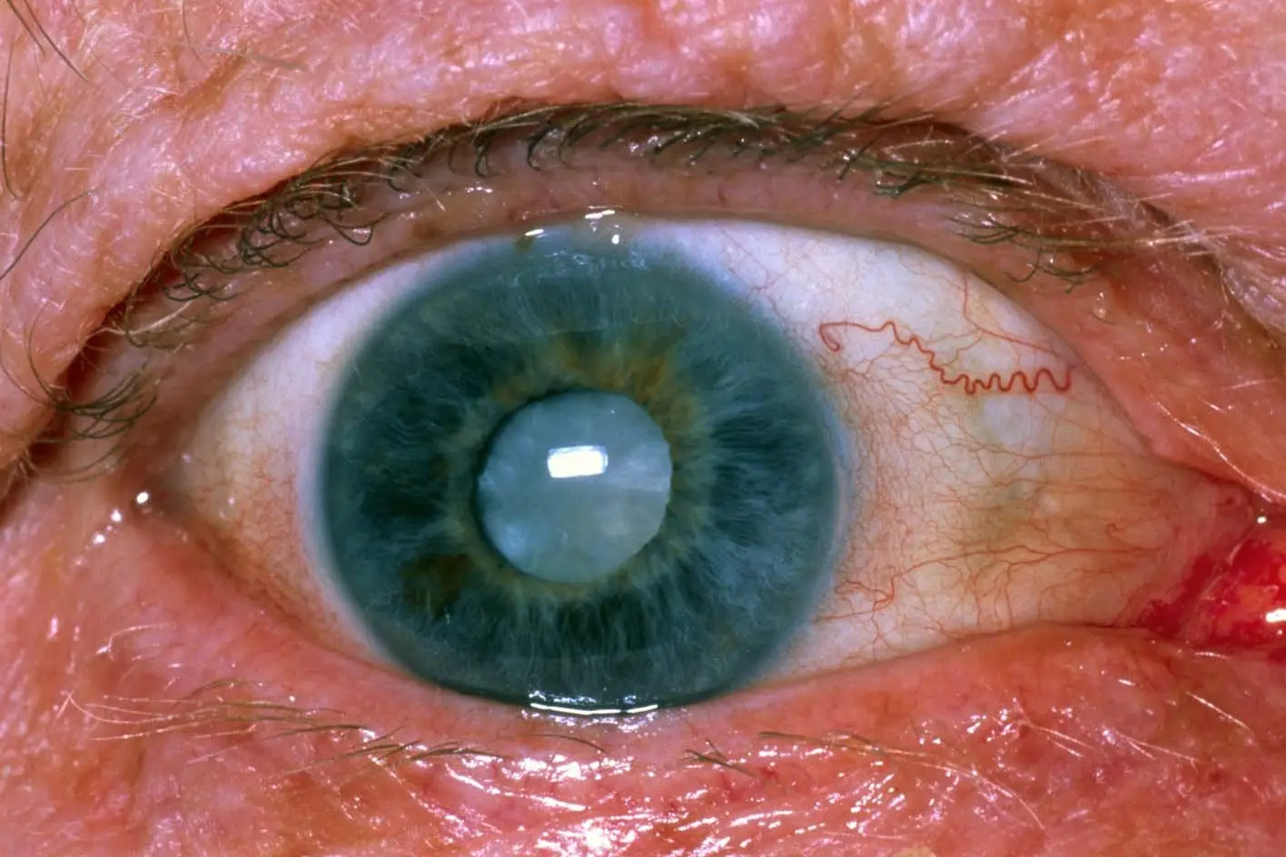 Cataracts can eventually lead to blindness (NHS)