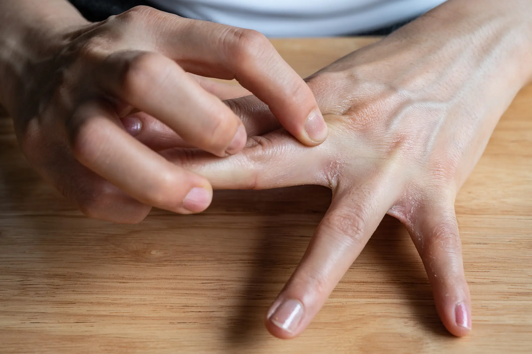 Scabies rashes can appear between the fingers (Boy_Anupong / Getty Images)