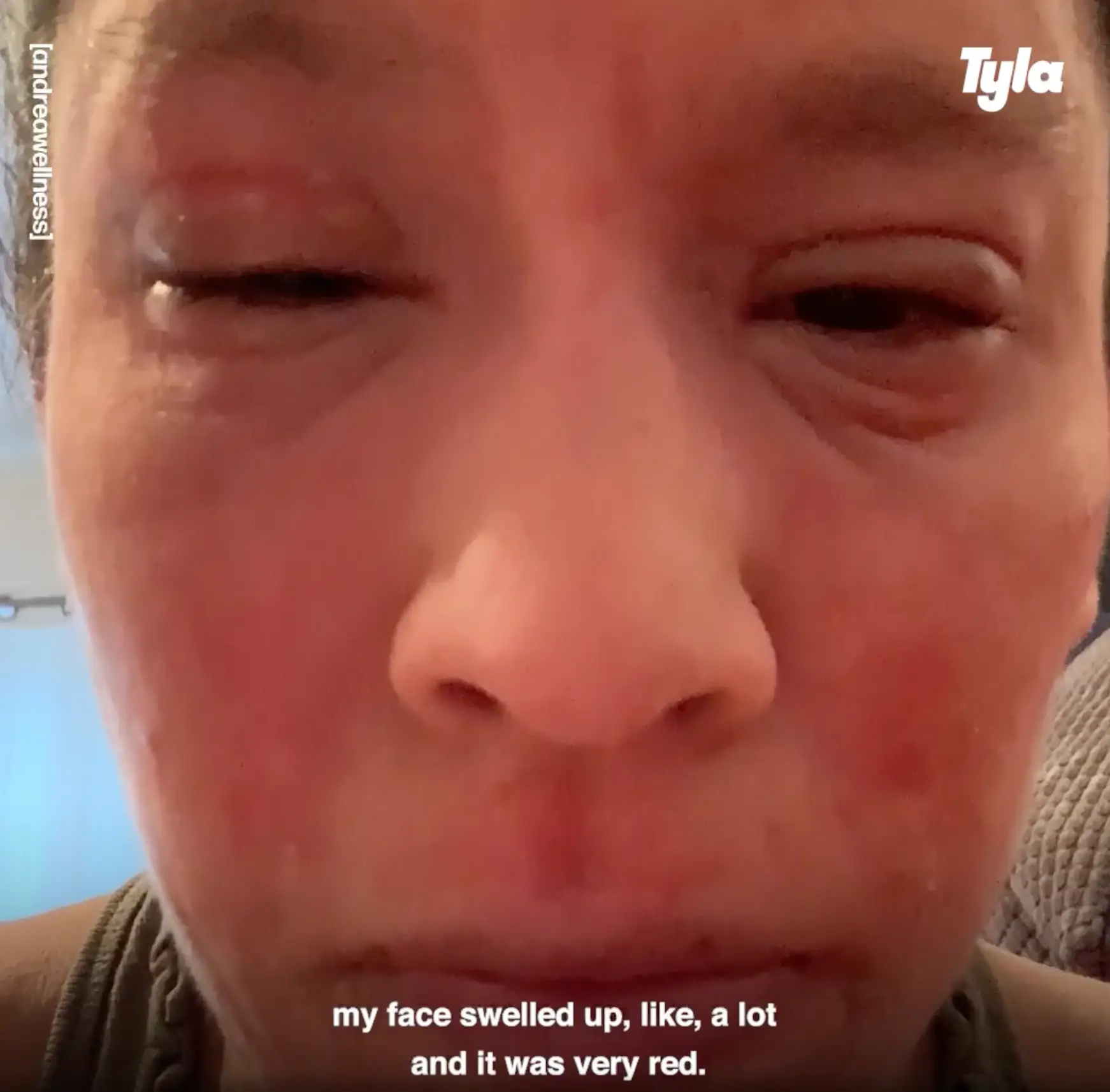 Her skin immediately swelled up.