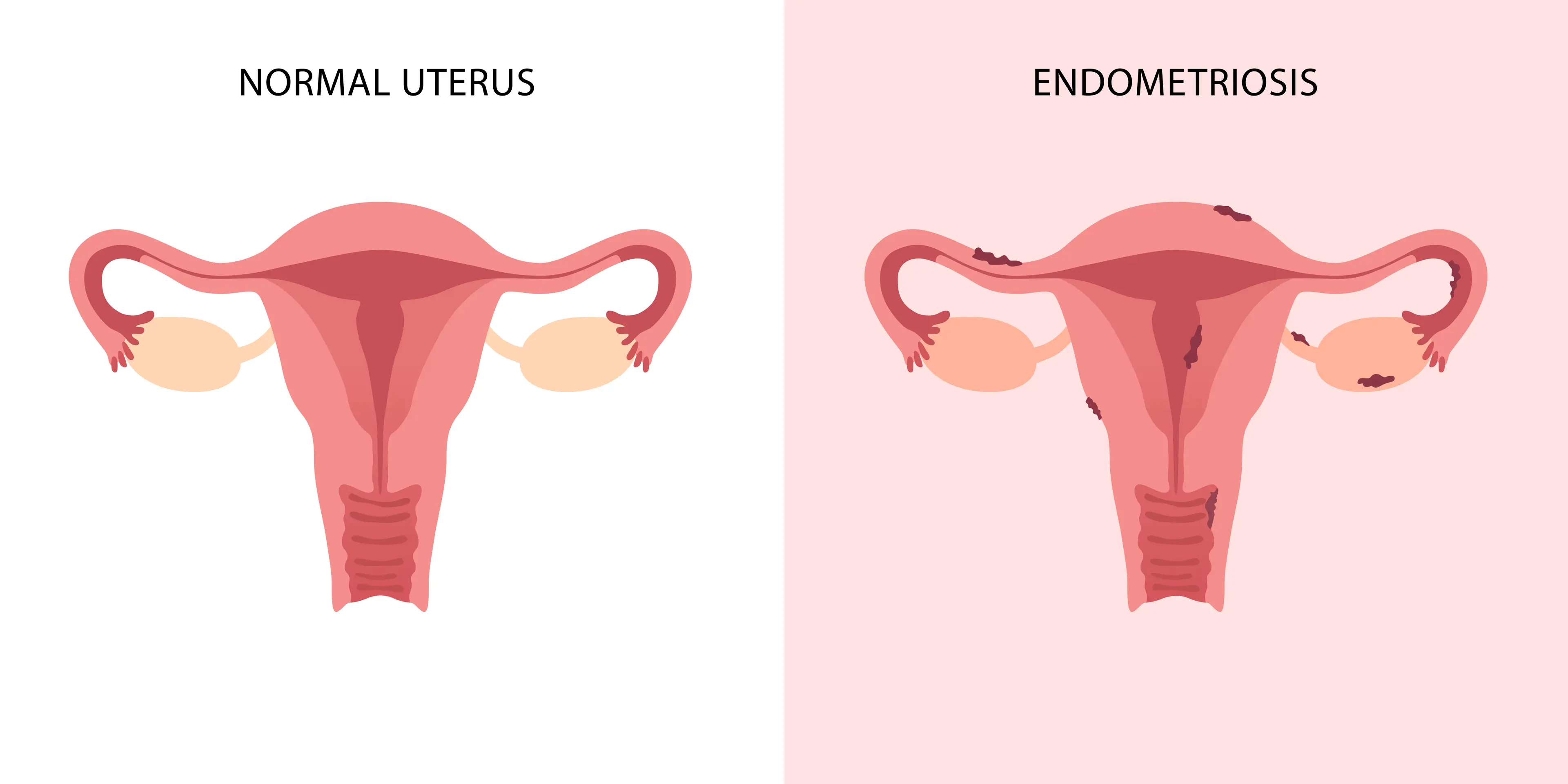 The chronic condition sees cells that make up the uterus growing outside of the area (Getty Stock Image)