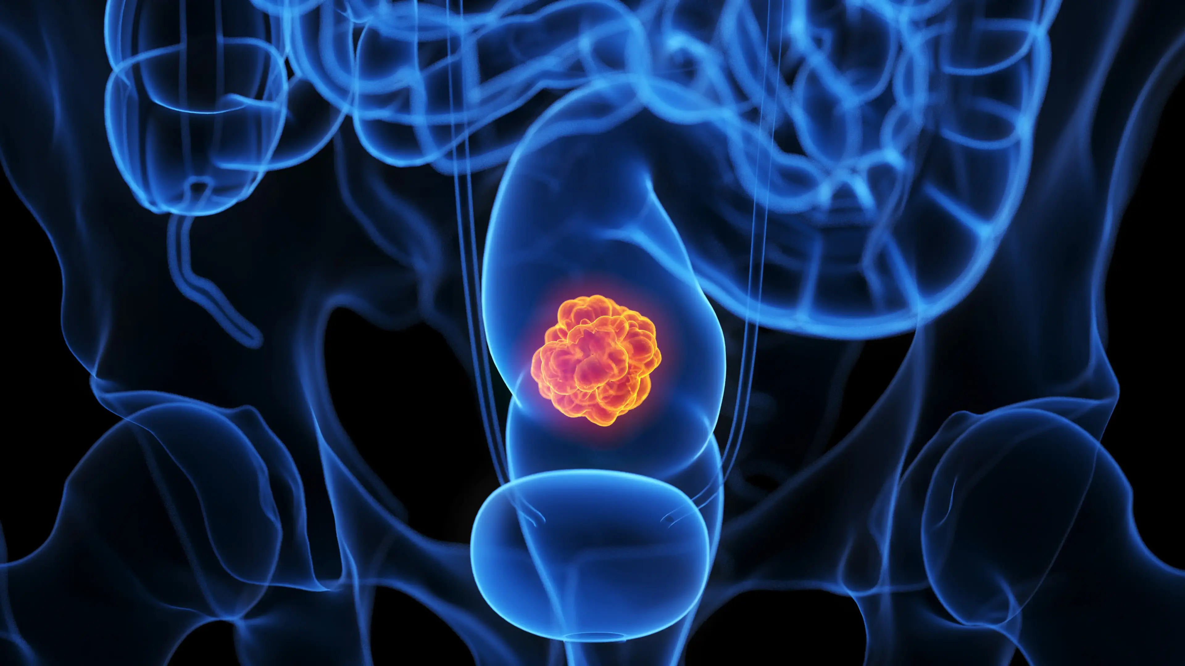 Many doctors believe cancer can be linked to poor diets (Science Photo Library/Getty Images)