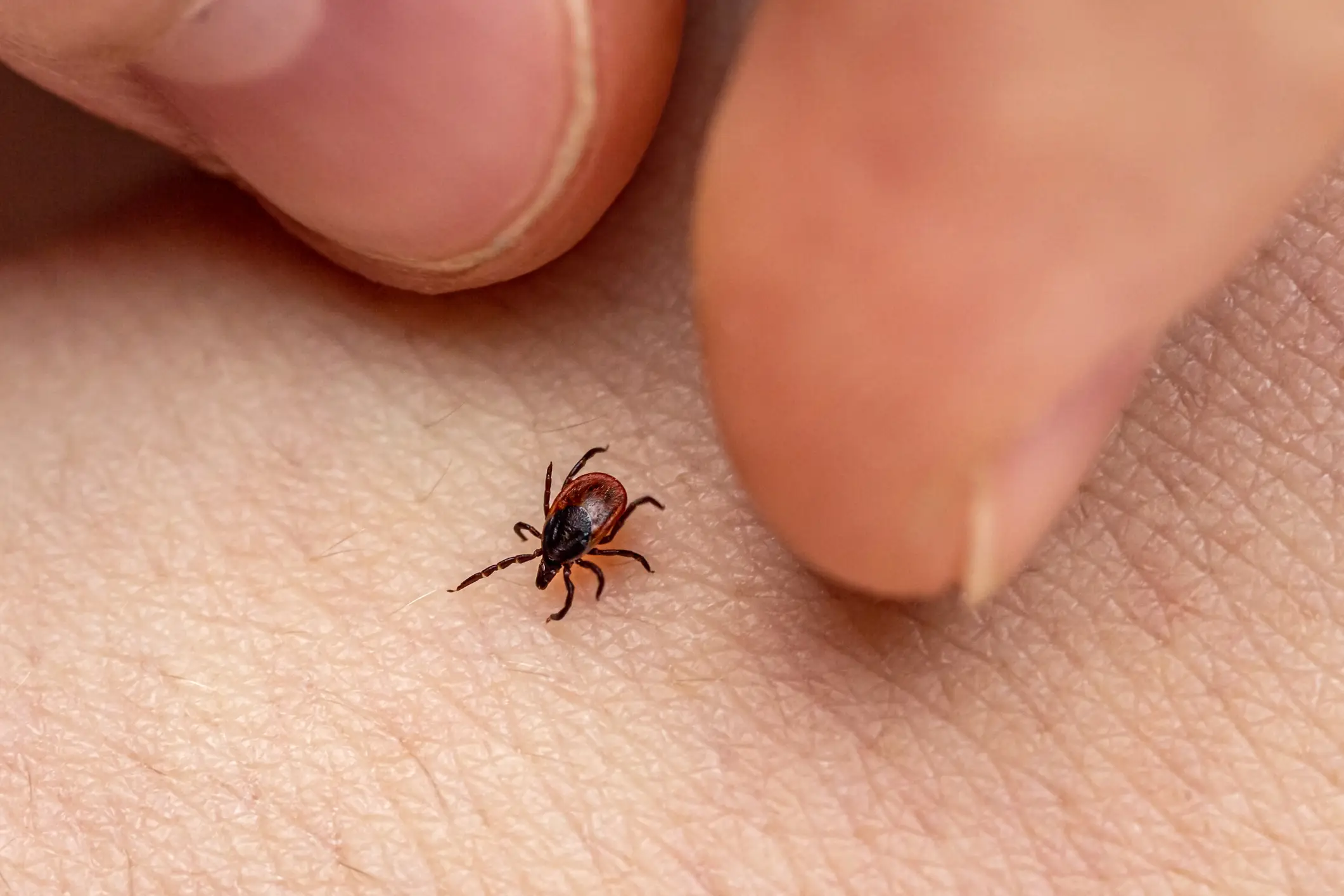 If you've been bitten by a tick, be sure to remove it carefully. (rbkomar / Getty Images)