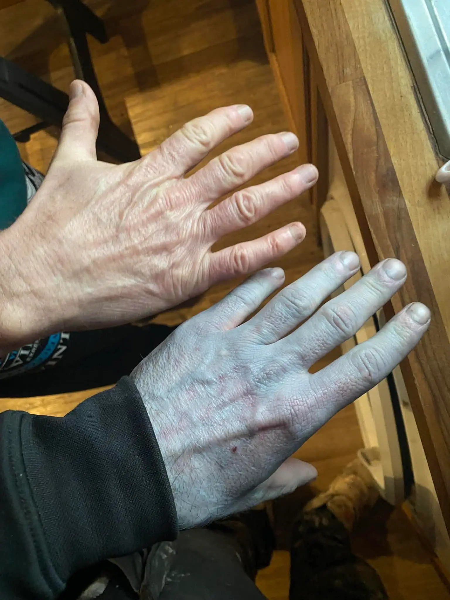 Tommy described his skin as being as blue as an 'Avatar' (SWNS)