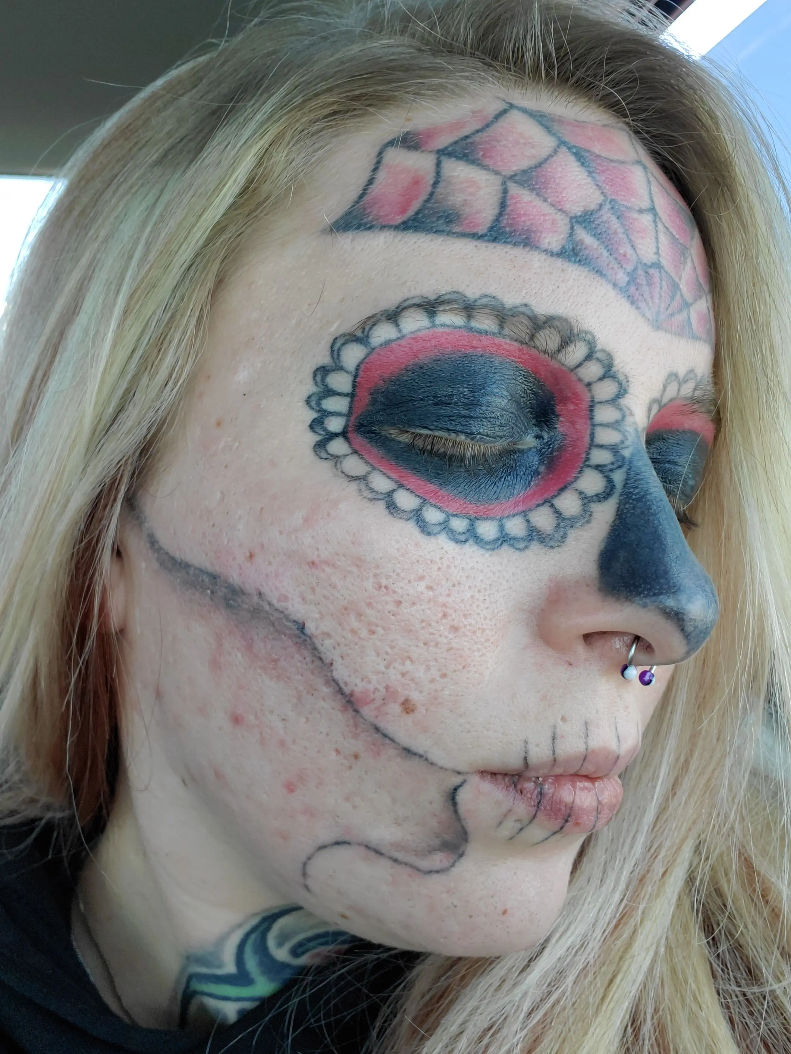 Alyssa has been attending sessions to have the tat removed.