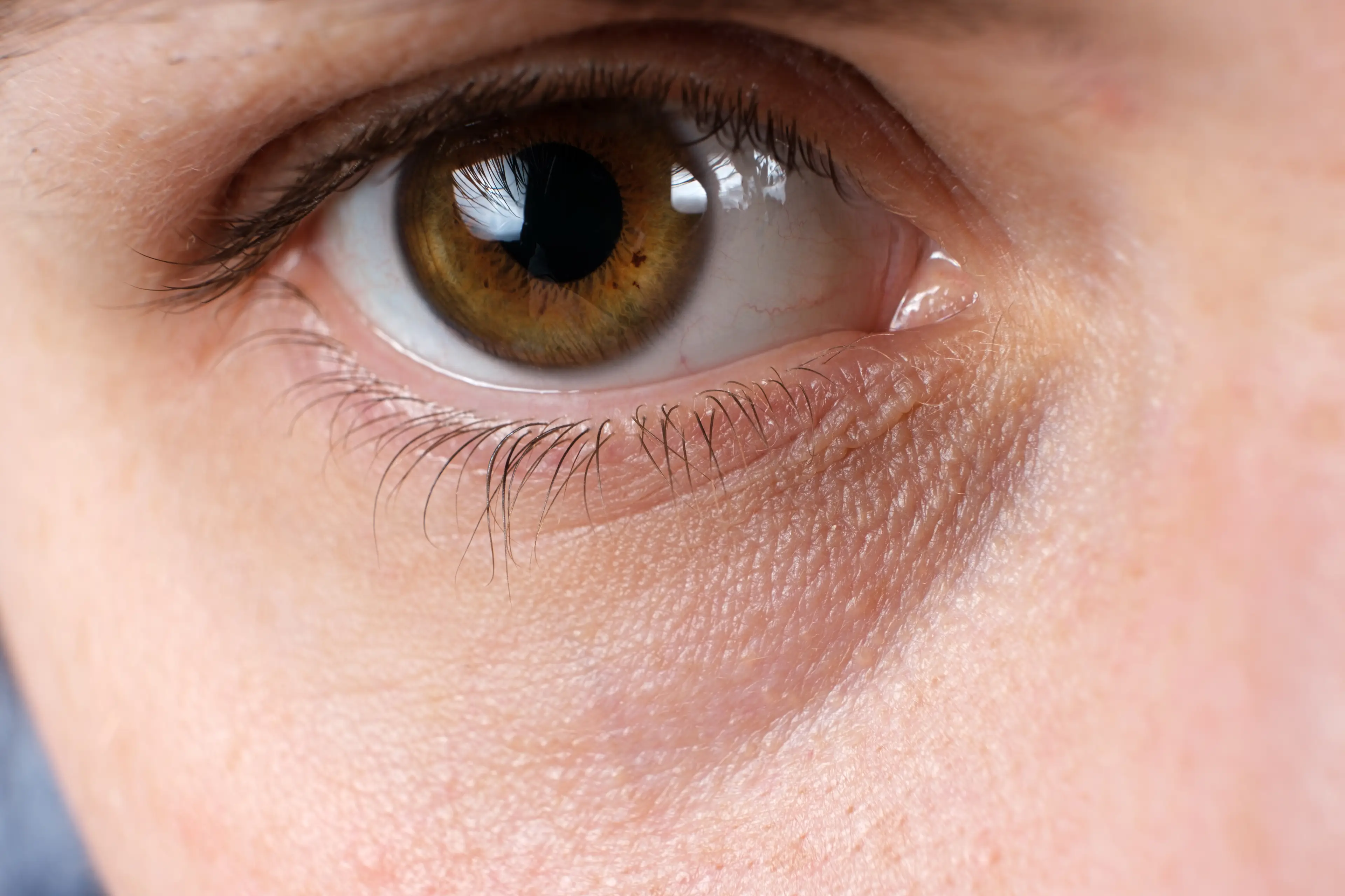 Dark circles may not just be a sign of tiredness (Zarina Lukash/Getty Images)