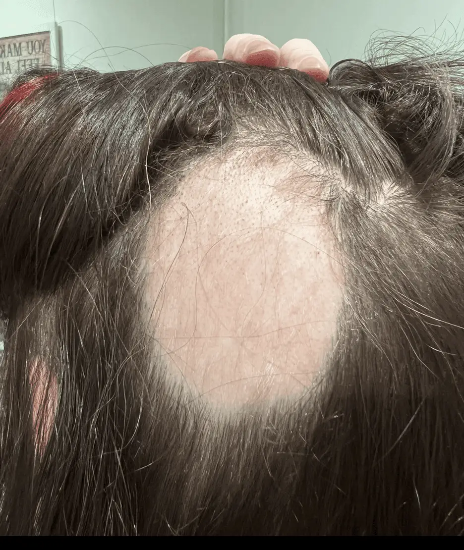 Jen started losing her hair in 2024 (Jen Thomas)