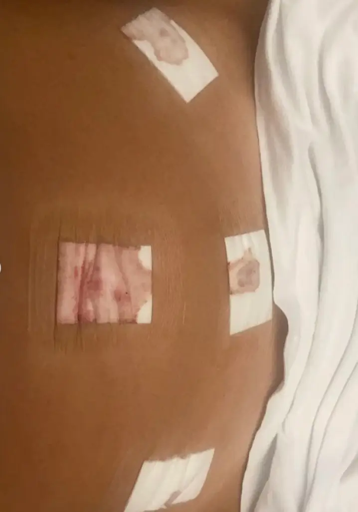 The Scotland-based woman had a laparoscopy a few months ago to diagnose her with the condition.