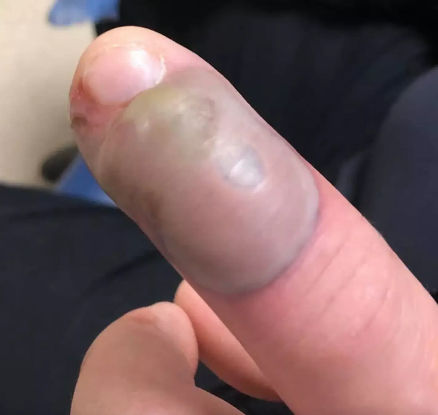 One woman's friend contracted a 'deadly infection' after biting her nails (Facebook/Karen Peat)