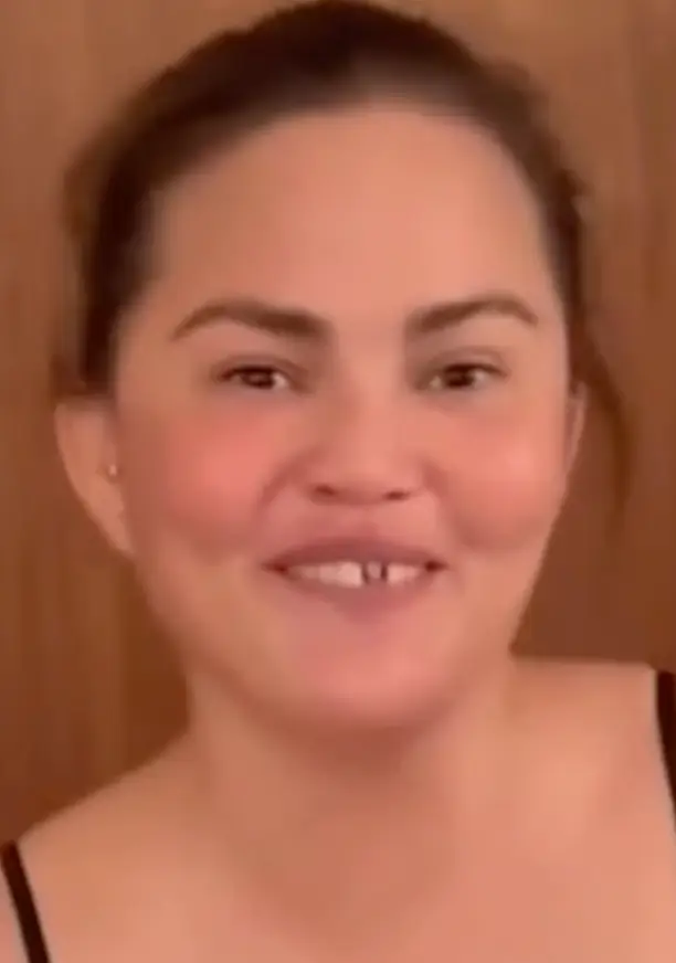 Chrissy explained that one of her two front teeth veneers came off (Instagram/@chrissyteigen)