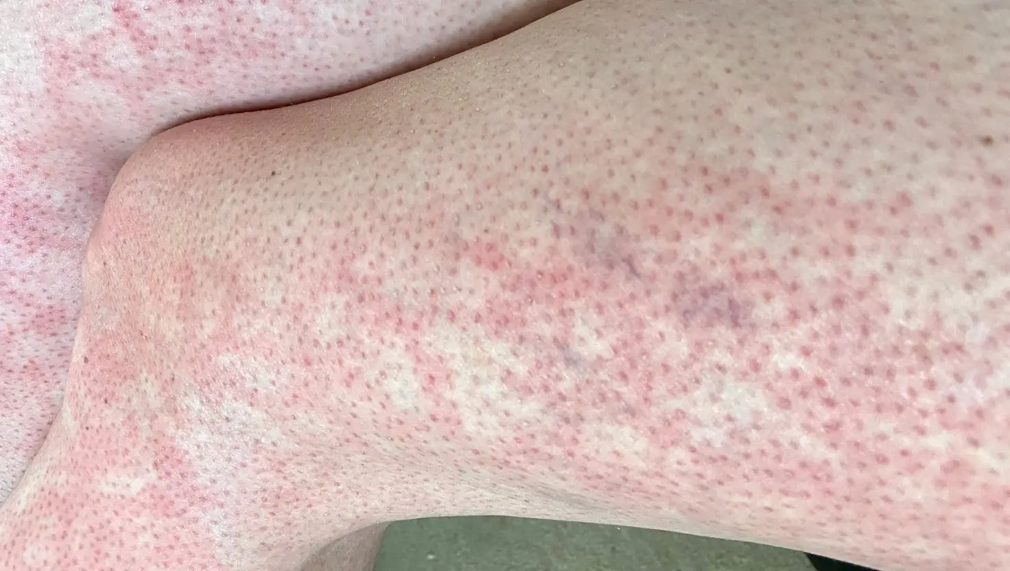 Mottled skin can appear if you're exposed to hot or cold elements, as well as indicate you're nearing the end of your life (Getty Stock Image)