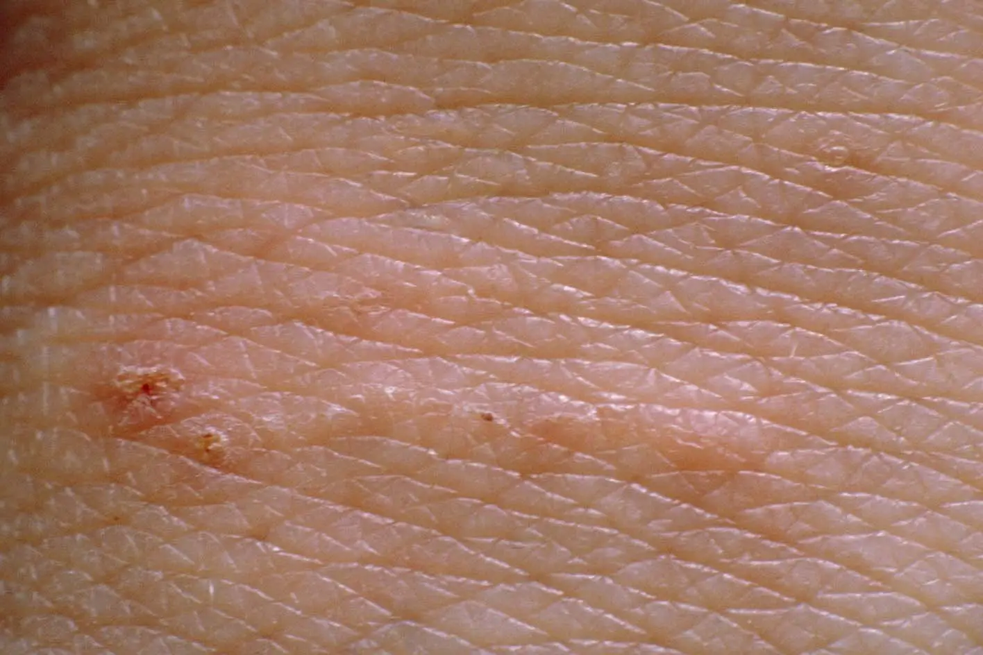 Tiny mites lay eggs in the skin, leaving lines with a dot at one end (NHS)