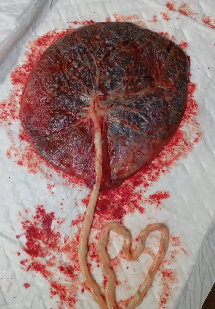 Harris shared a photo of Hope's placenta (Instagram/@calvinharris)