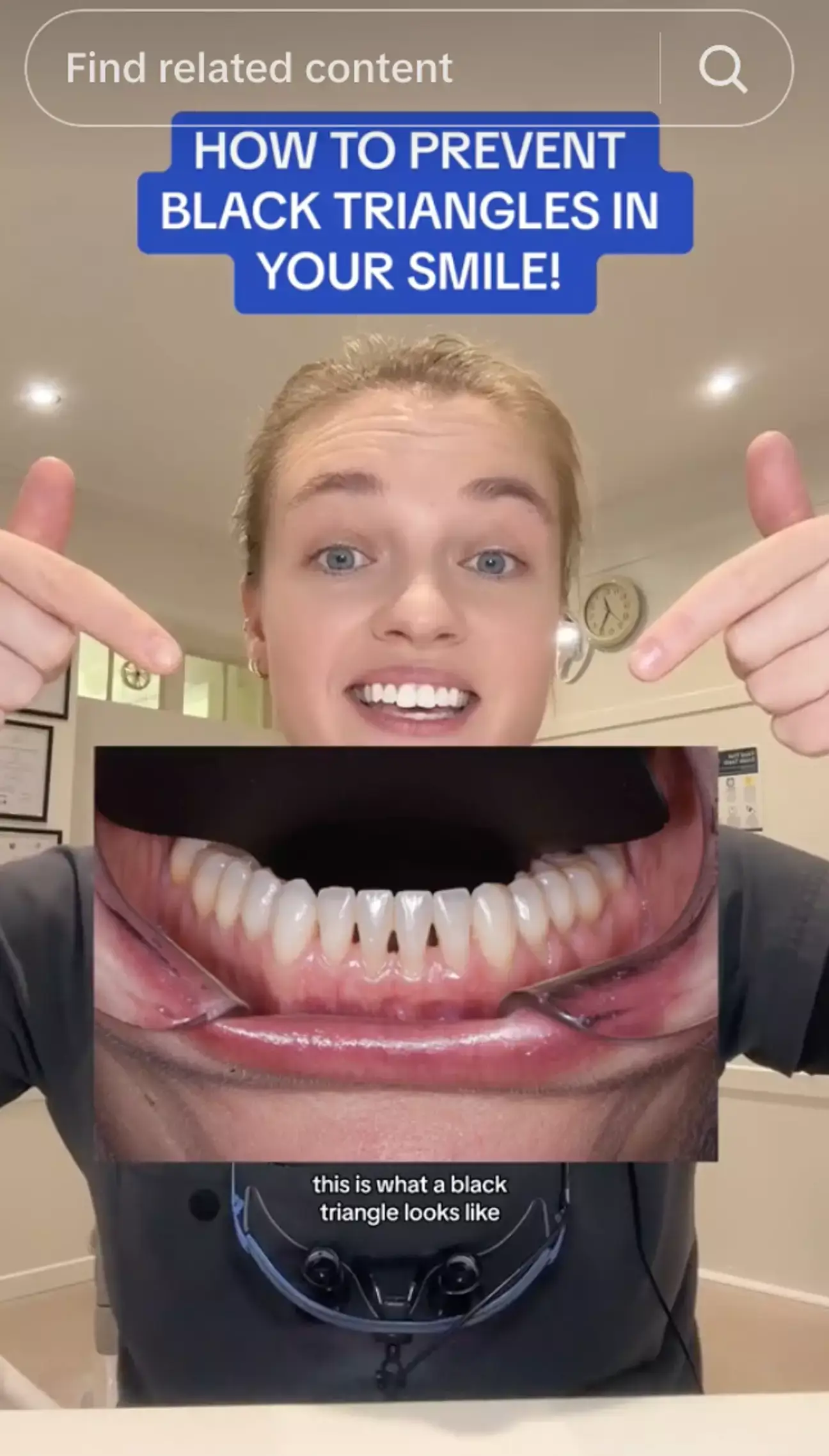 There 'several potential reasons' why black triangles may start forming in between your teeth.