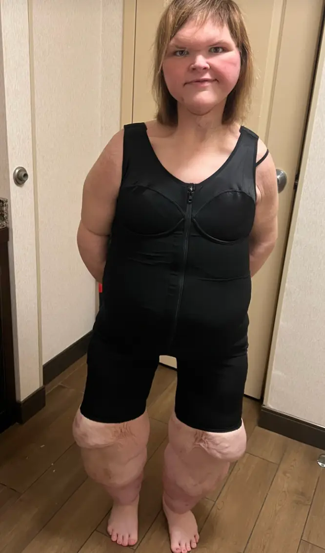 1000-lb Sisters star, Tammy Slaton, shared a number of post-op snaps to social media over the weekend (TikTok/@tammy.l.slaton)