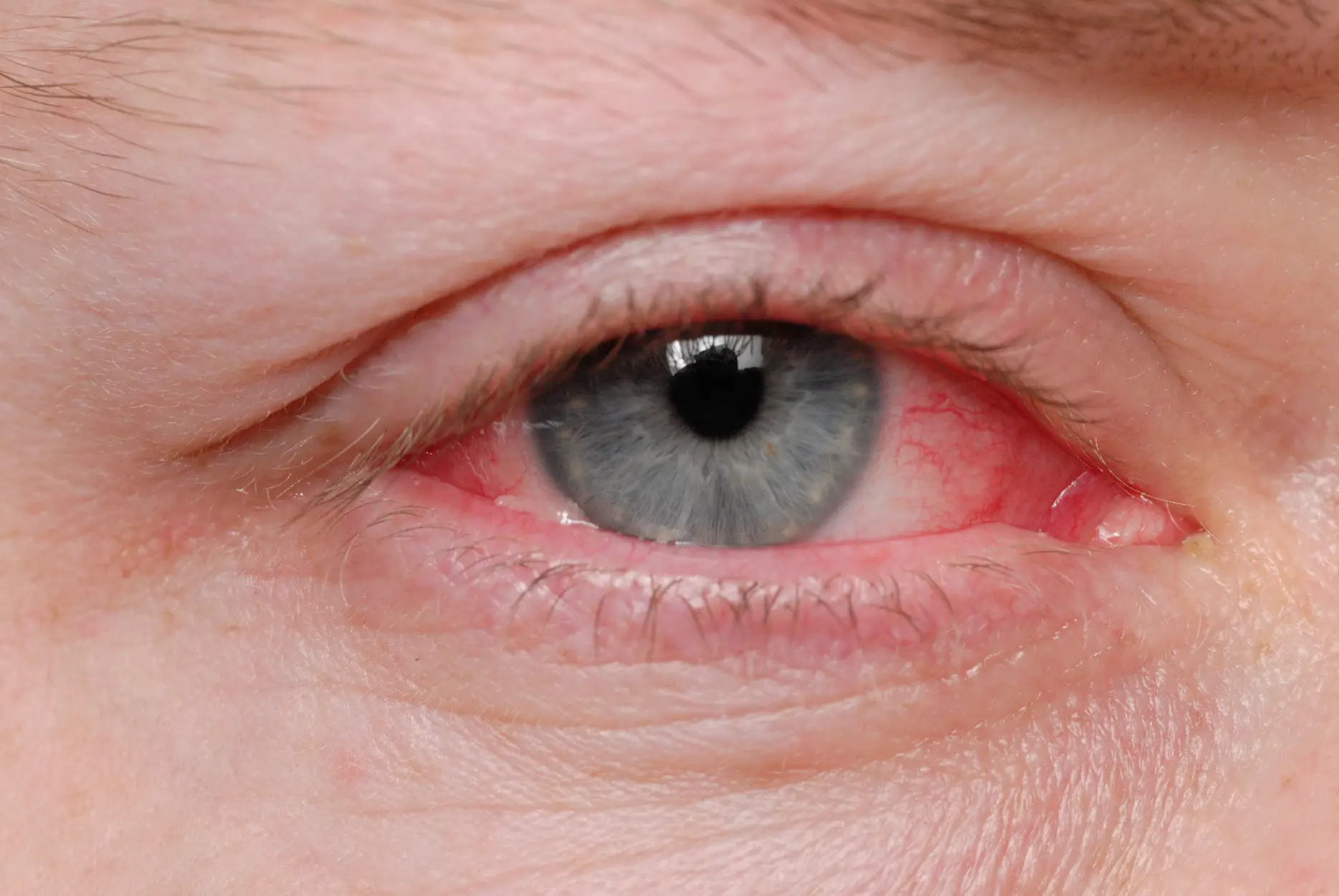 One of the biggest red flag symptoms is conjunctivitis, also known as pink eye (Getty Stock Image)